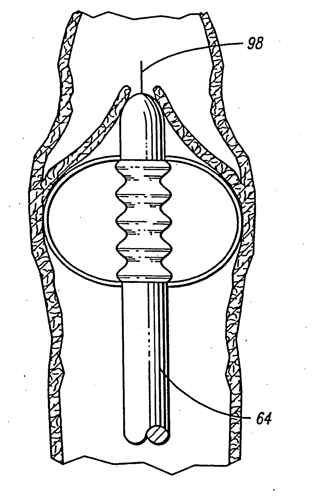 Apparatus for Treating Venous Insufficiency Using Directionally Applied Energy