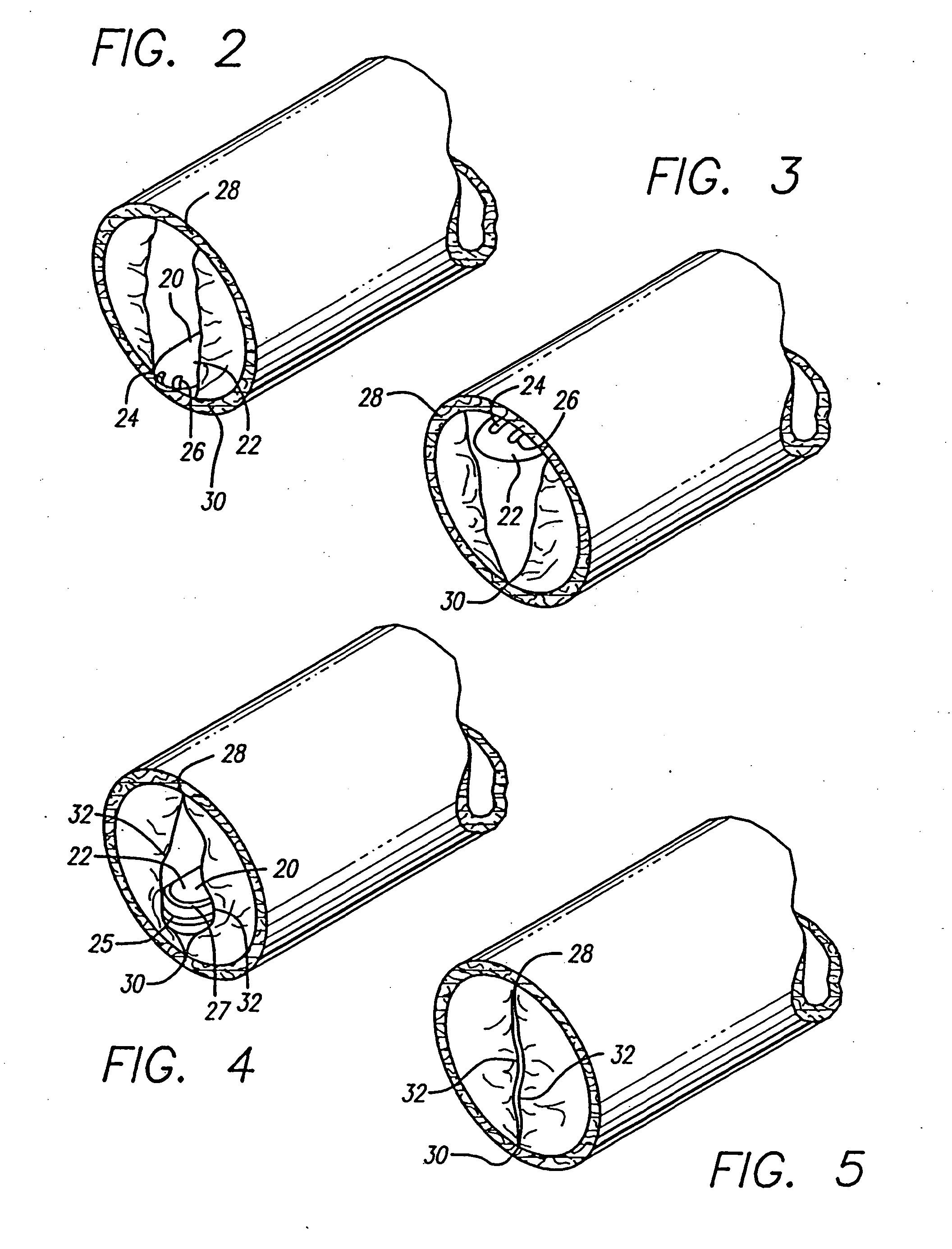 Apparatus for Treating Venous Insufficiency Using Directionally Applied Energy