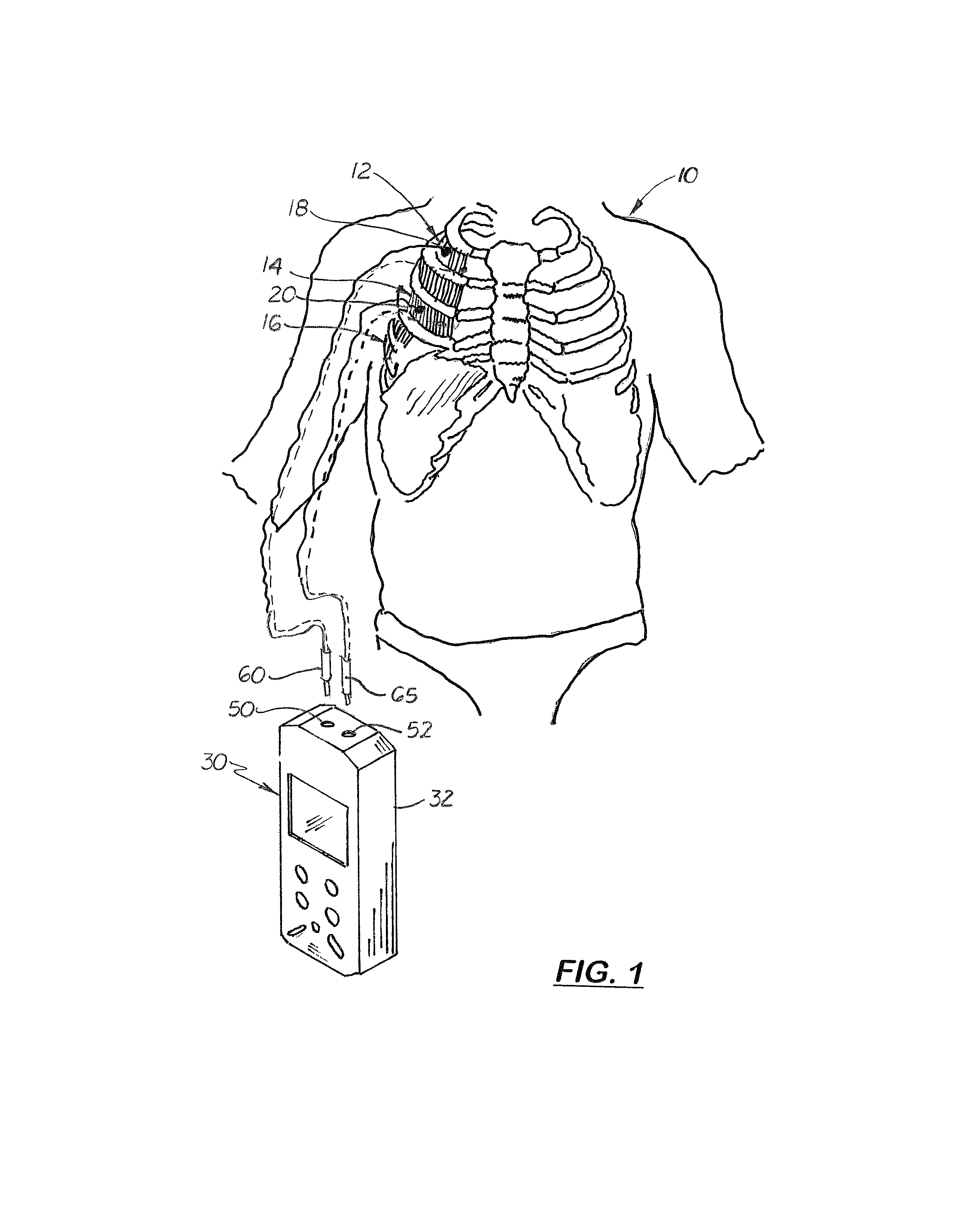 Apparatus and method for treating sleep apnea