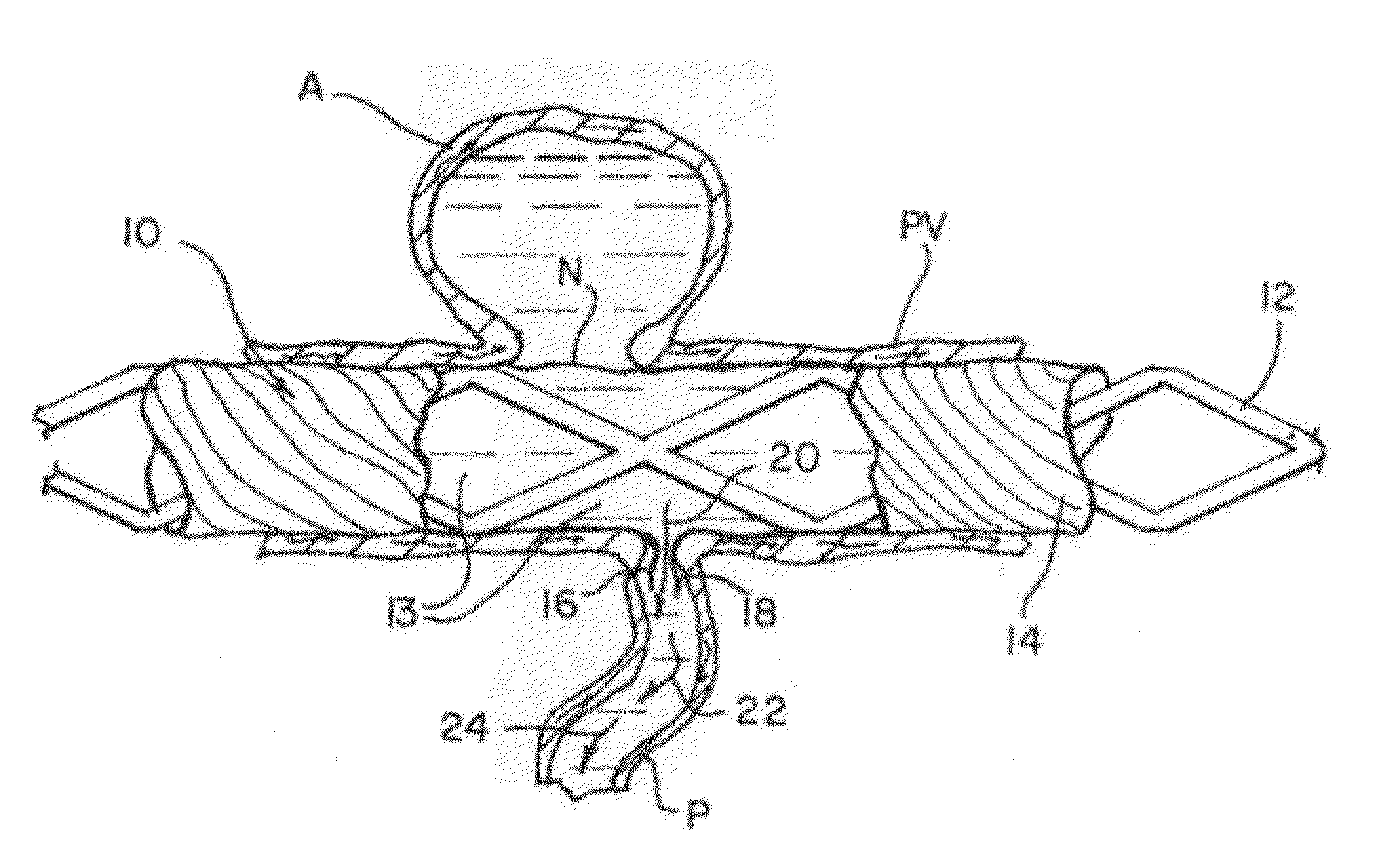 Modifiable occlusion device