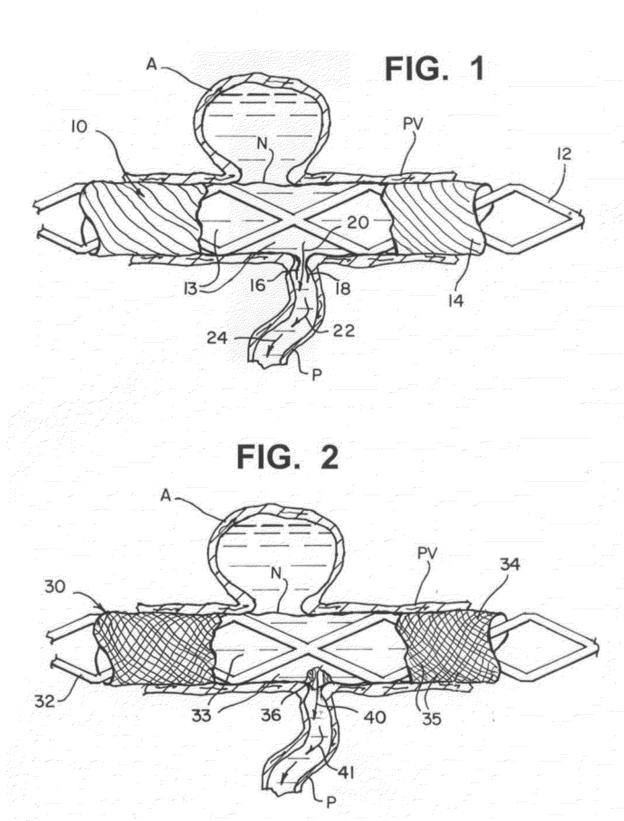 Modifiable occlusion device