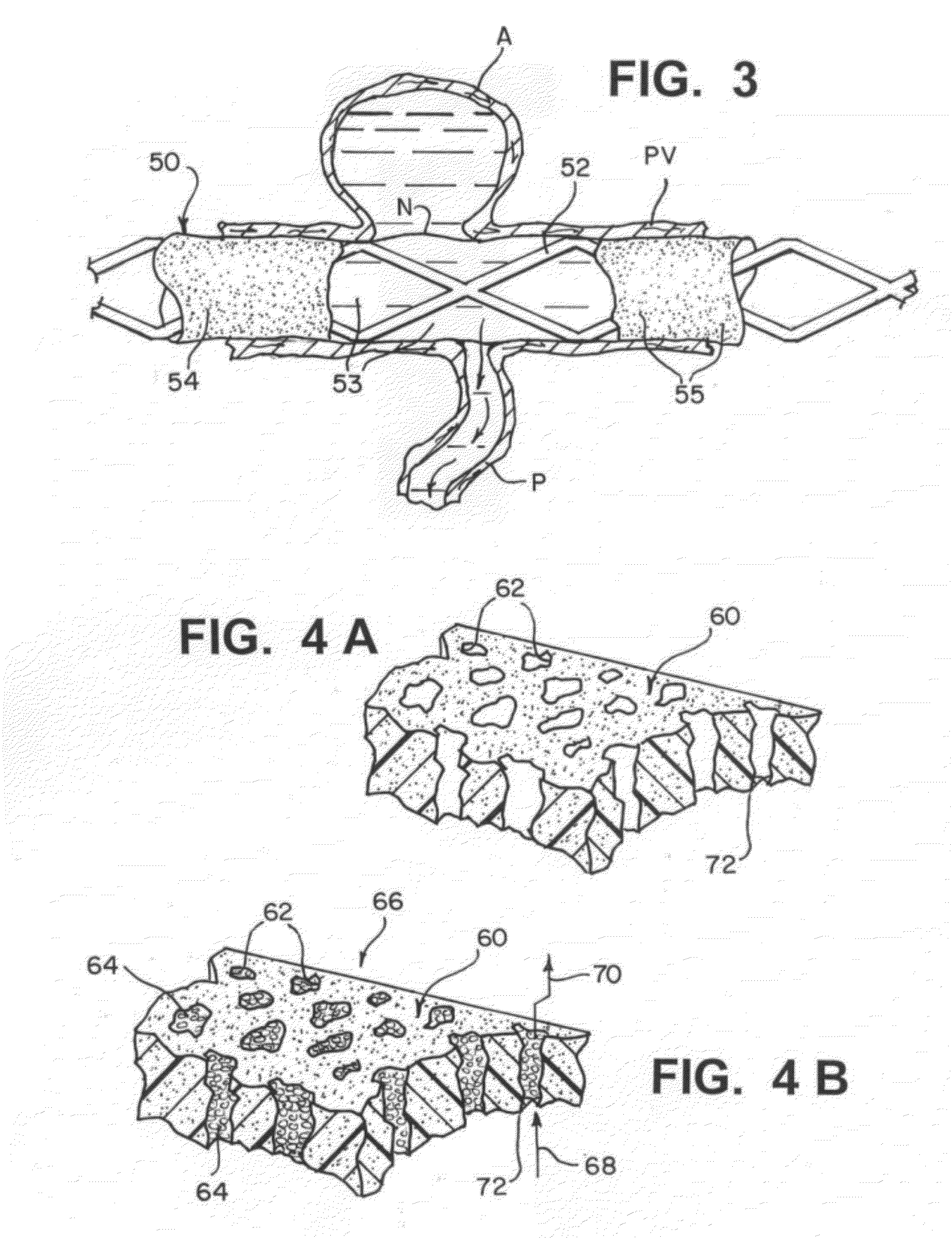 Modifiable occlusion device