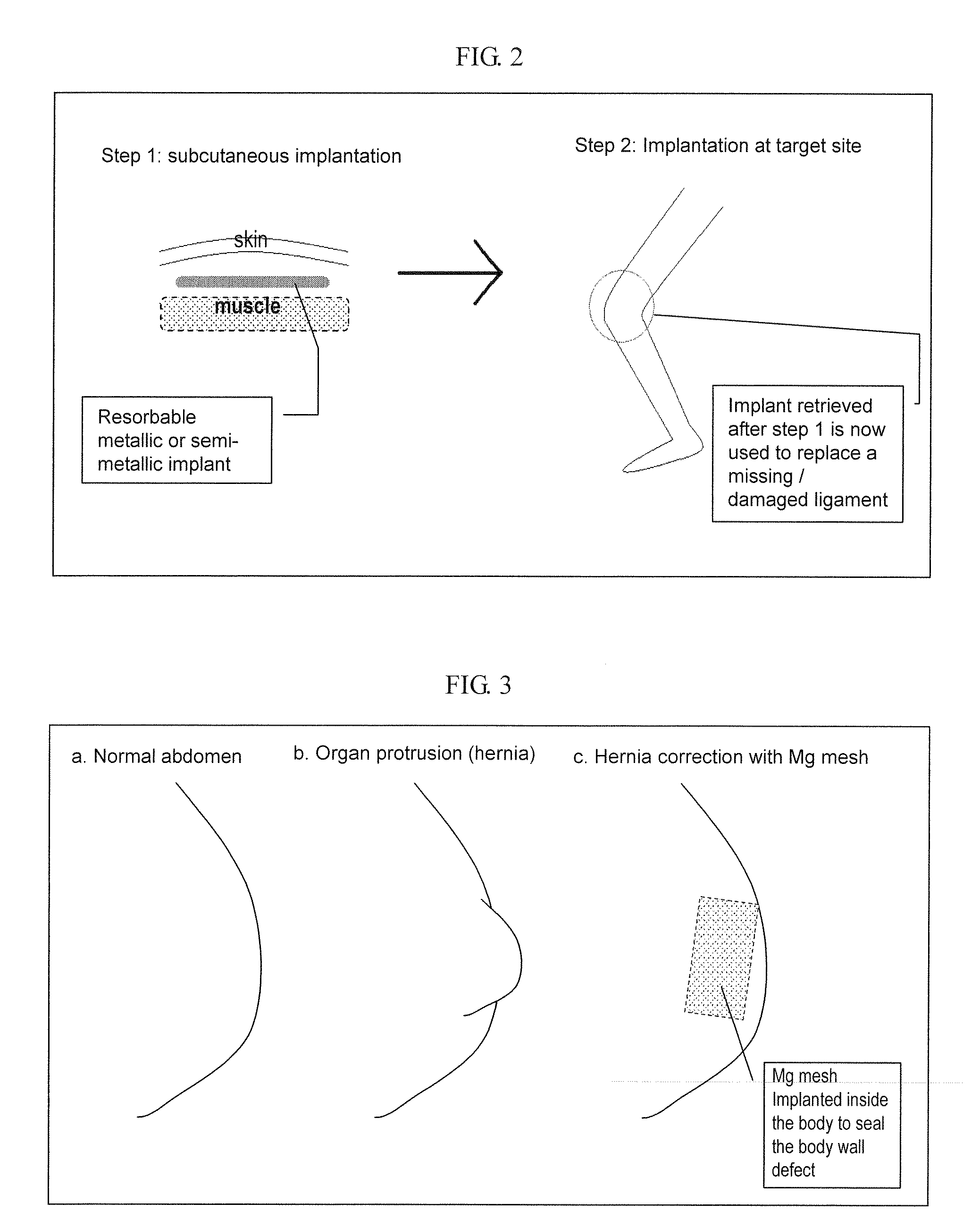 Implant for Tissue Engineering