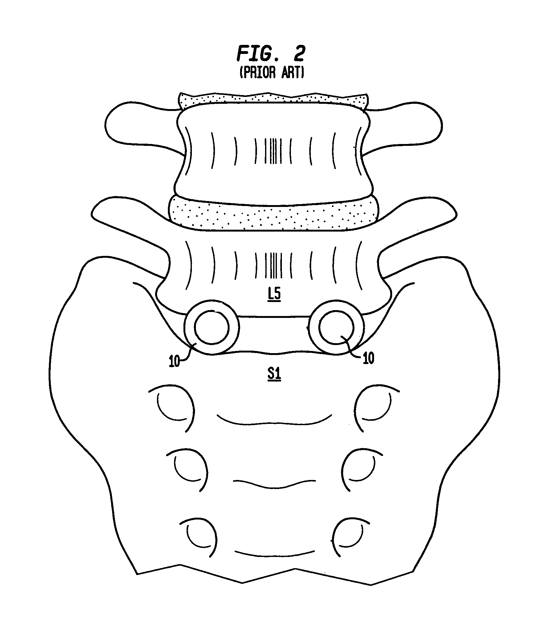 Intervertebral spacer device having a radially thinning belleville spring