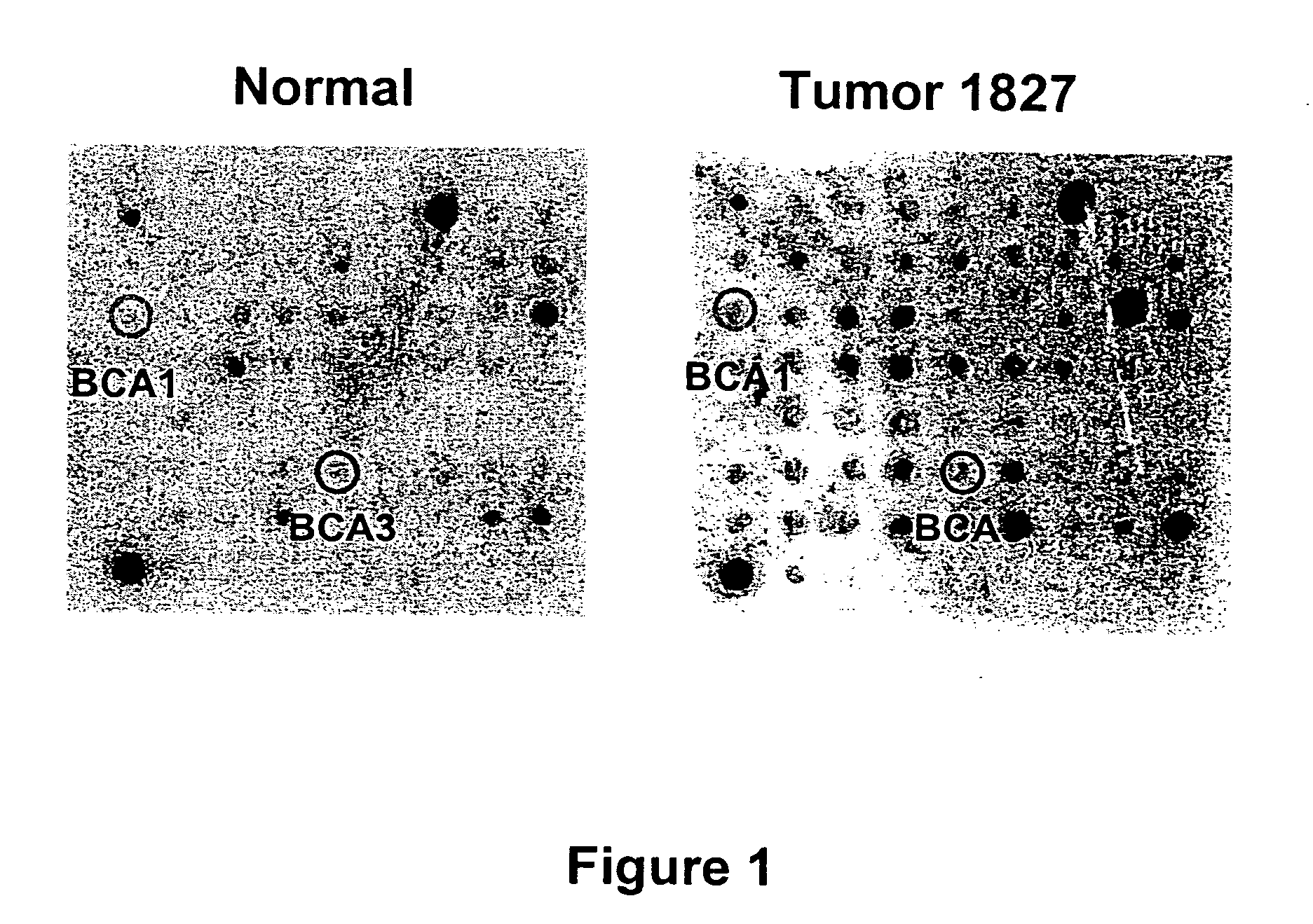 Breast cancer-associated genes and uses thereof