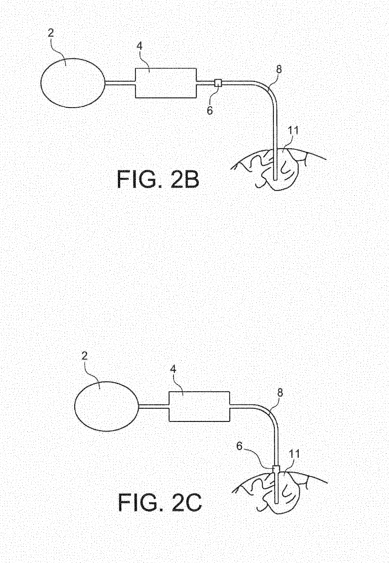 Closed loop system for controlling the reflux of a fluid injection