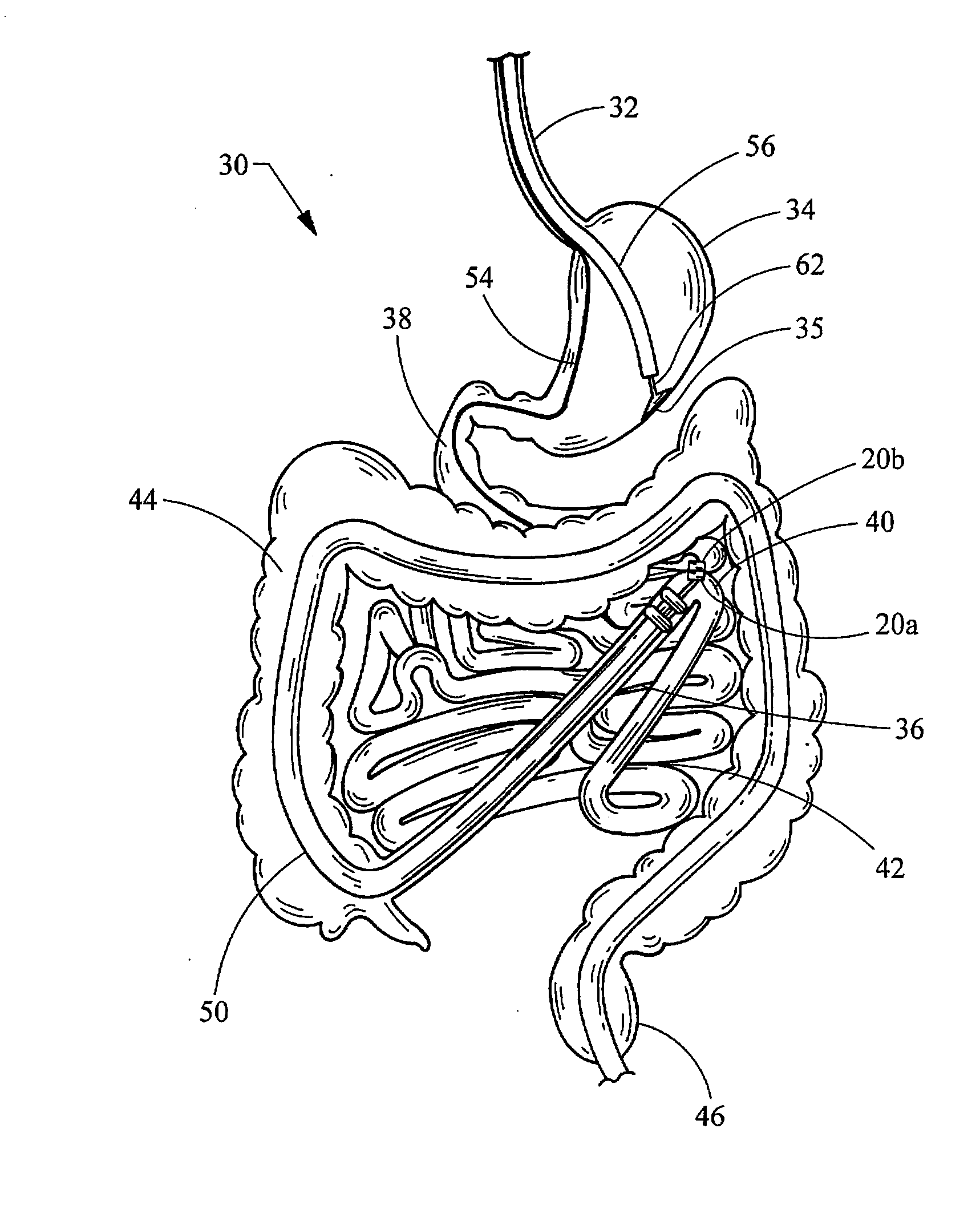 Intestinal bypass using magnets