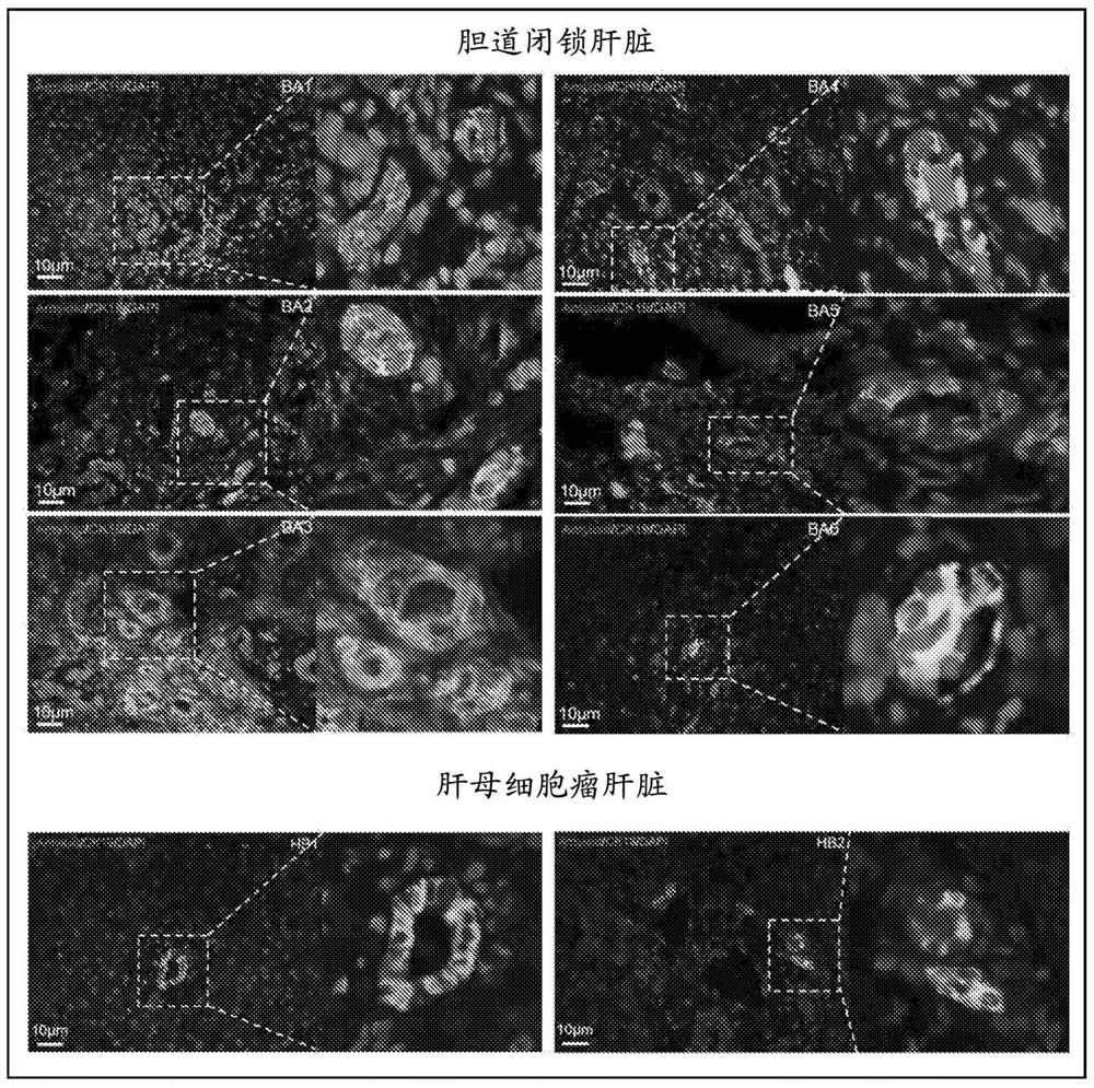 Amyloid precursor protein as a diagnostic marker for biliary atresia