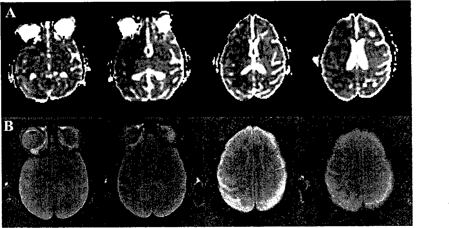 Method for establishing artery ischemia model of brain of rhesus monkey and evaluation method