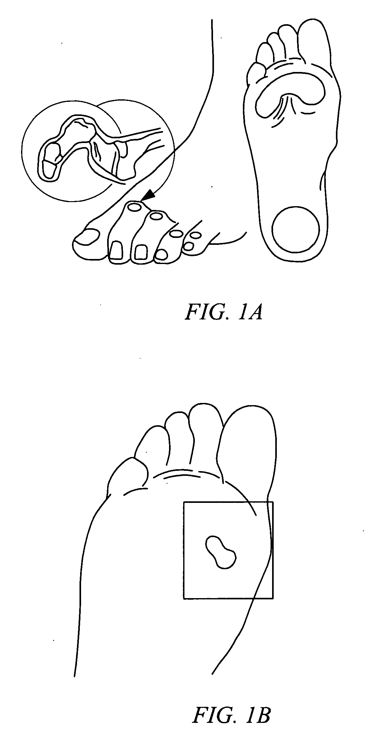 Electrosurgical method and system for treating foot ulcer