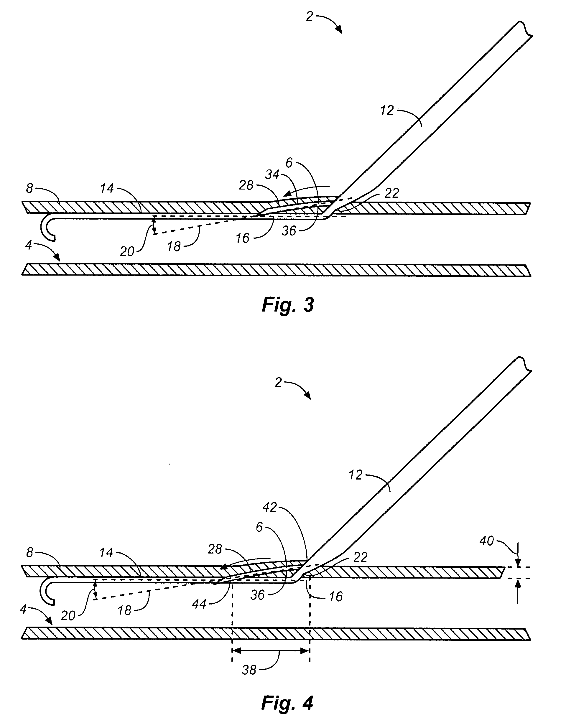 Access and closure device and method