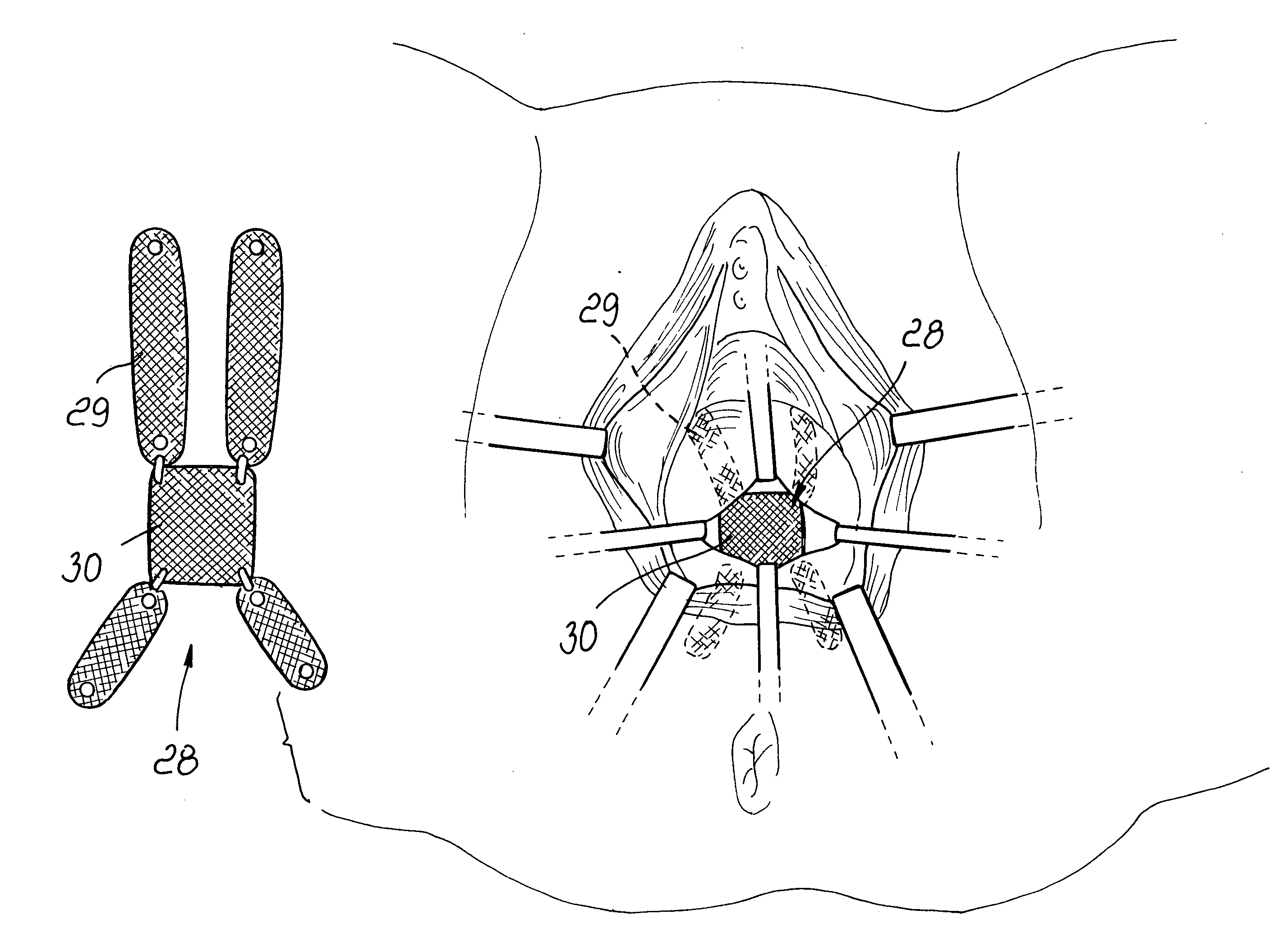 Surgical procedure for correcting cystocele and rectocele