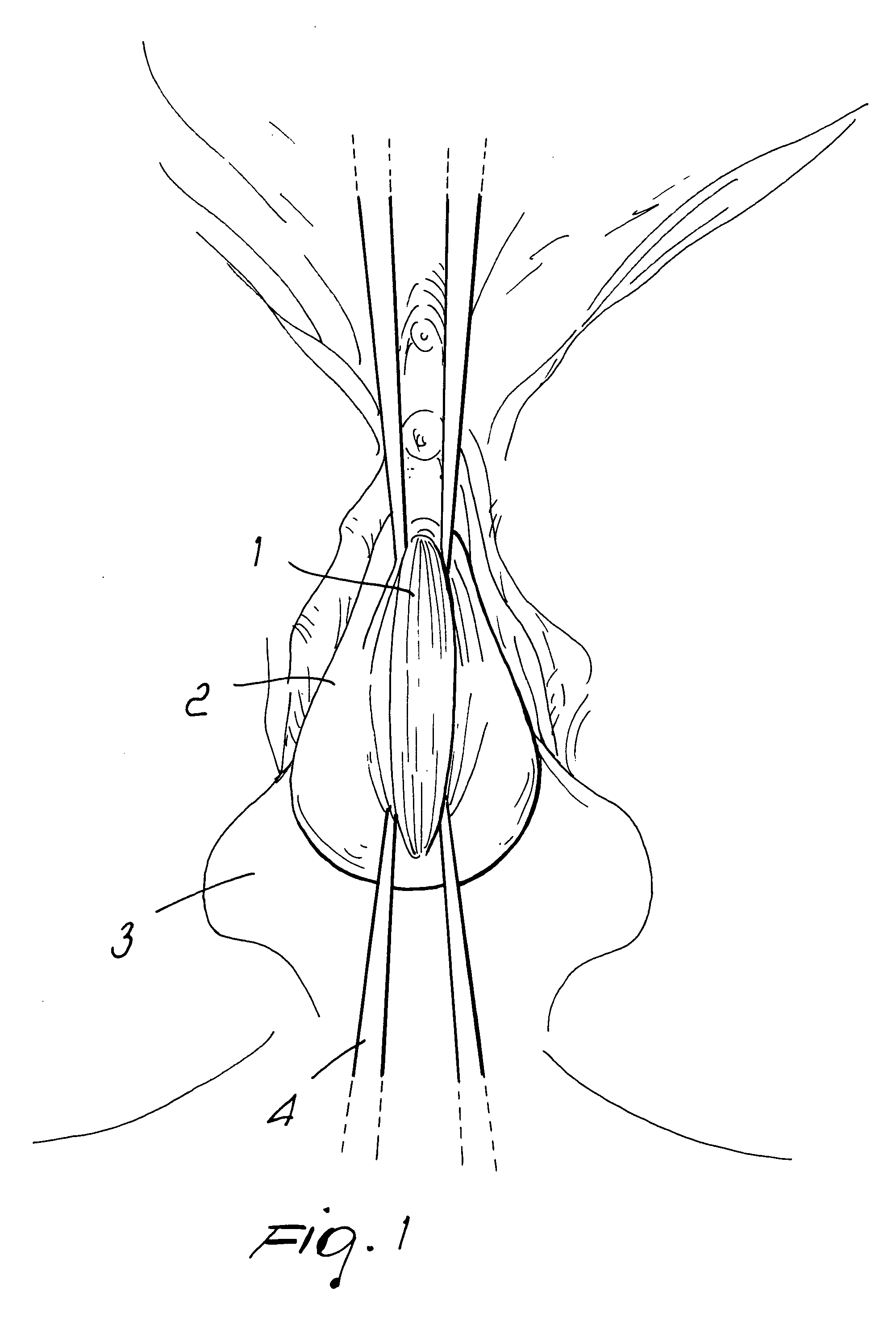 Surgical procedure for correcting cystocele and rectocele