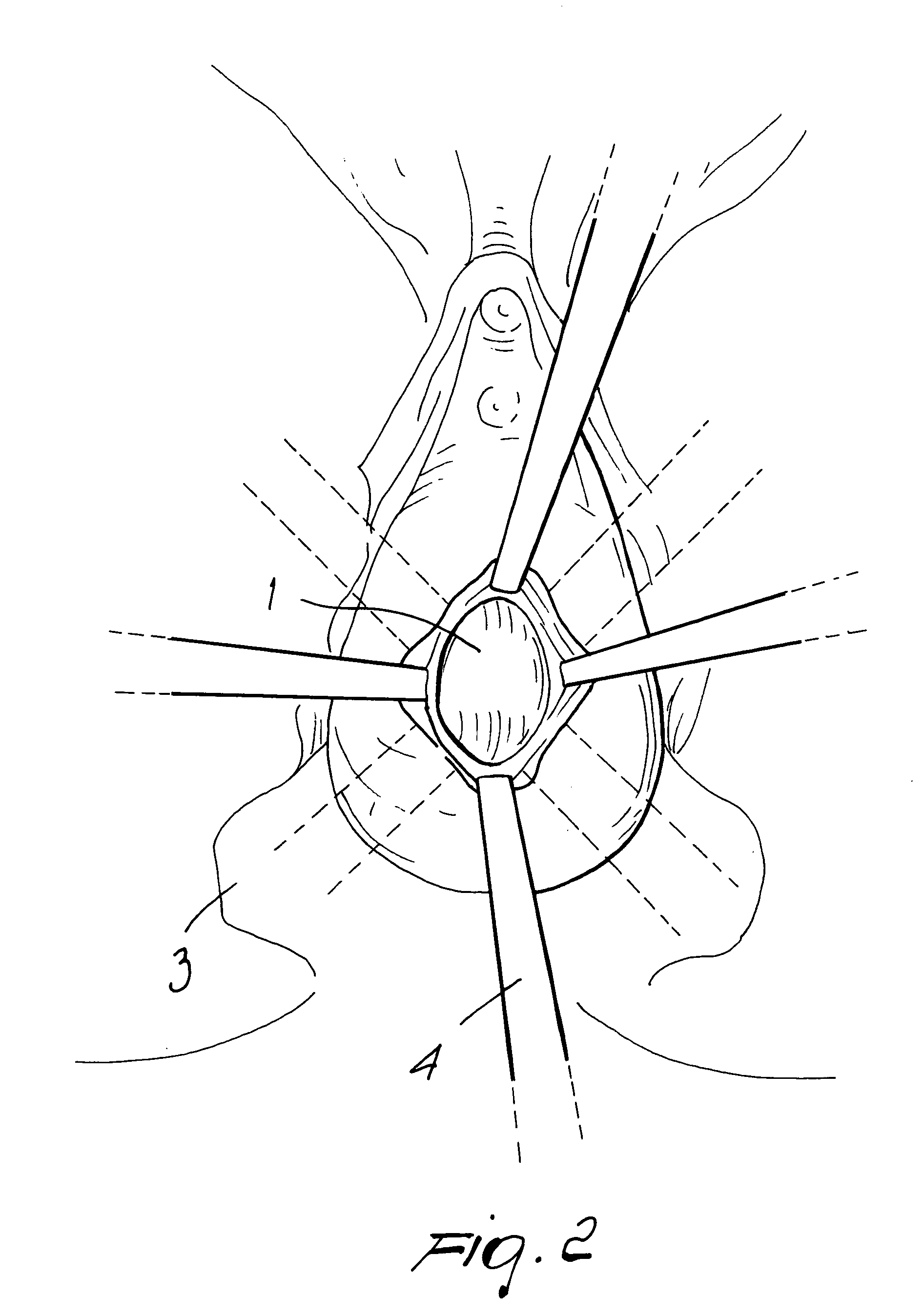 Surgical procedure for correcting cystocele and rectocele