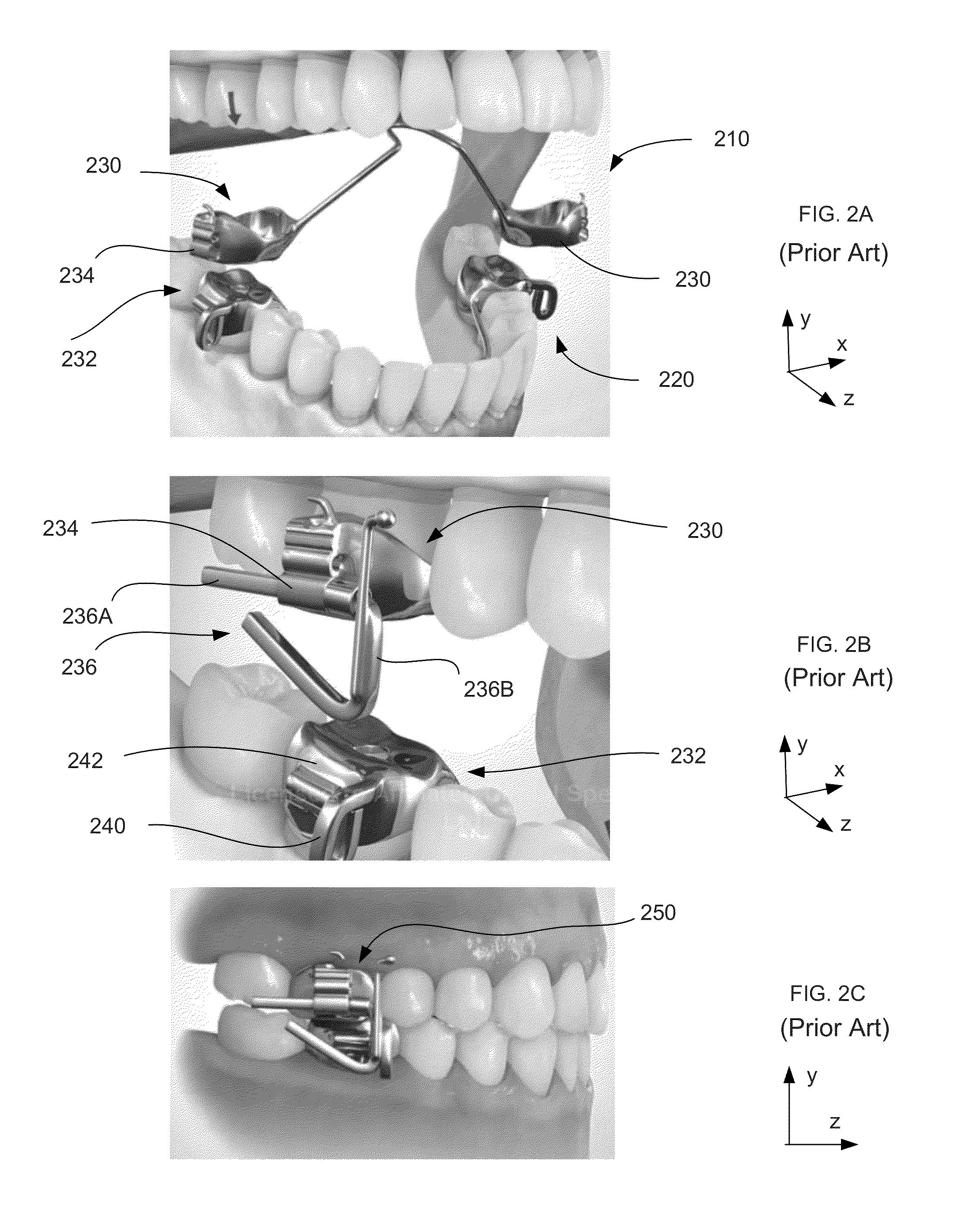 Mandibular attachment for correction of malocclusion