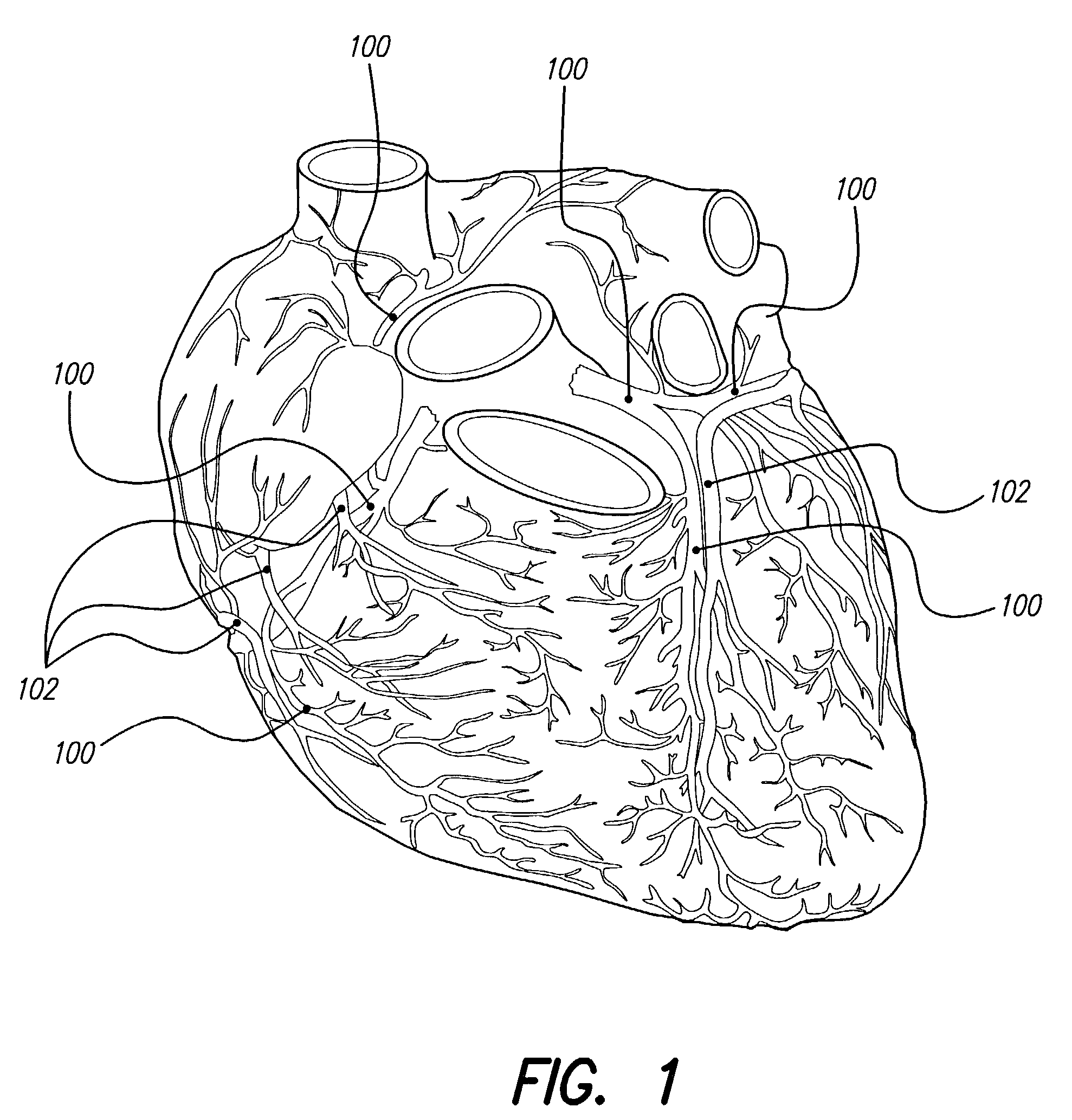 Systems and methods for treatment of coronary artery disease