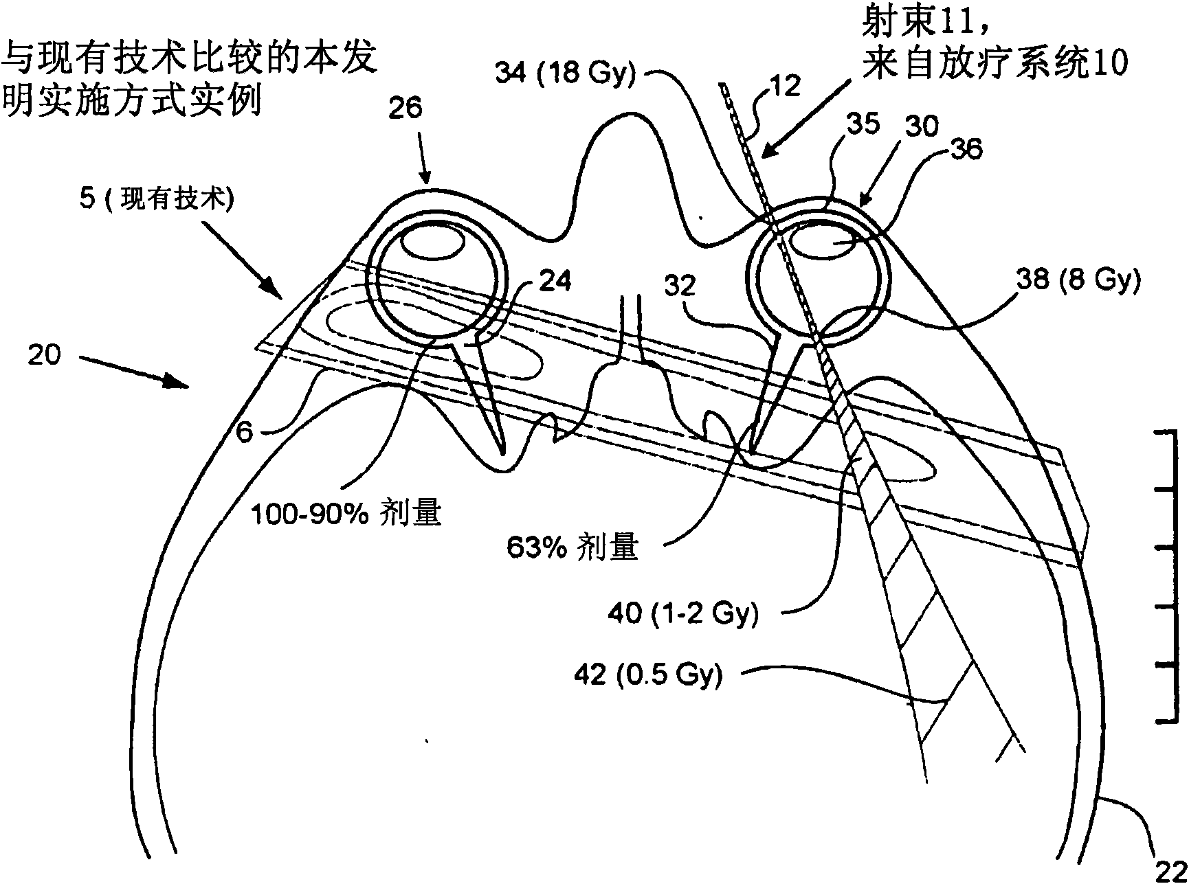 Methods and devices for orthovoltage ocular radiotherapy and treatment planning