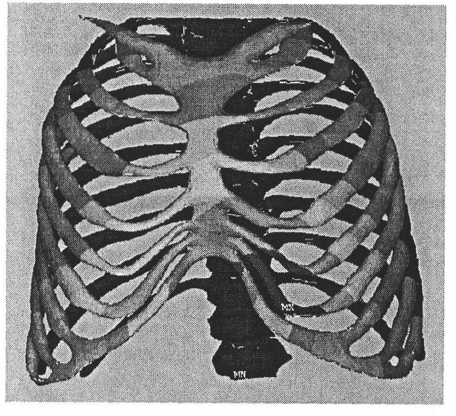 Simulation method for funnel breast orthopaedic surgery