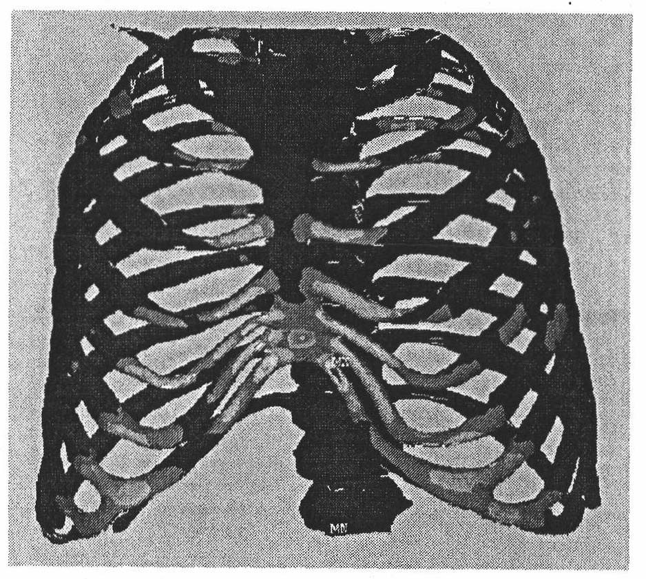 Simulation method for funnel breast orthopaedic surgery