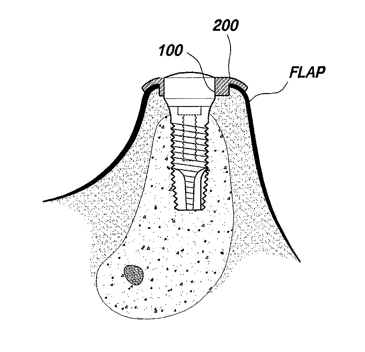 Button for implant healing abutment and implant healing abutment having pressing part