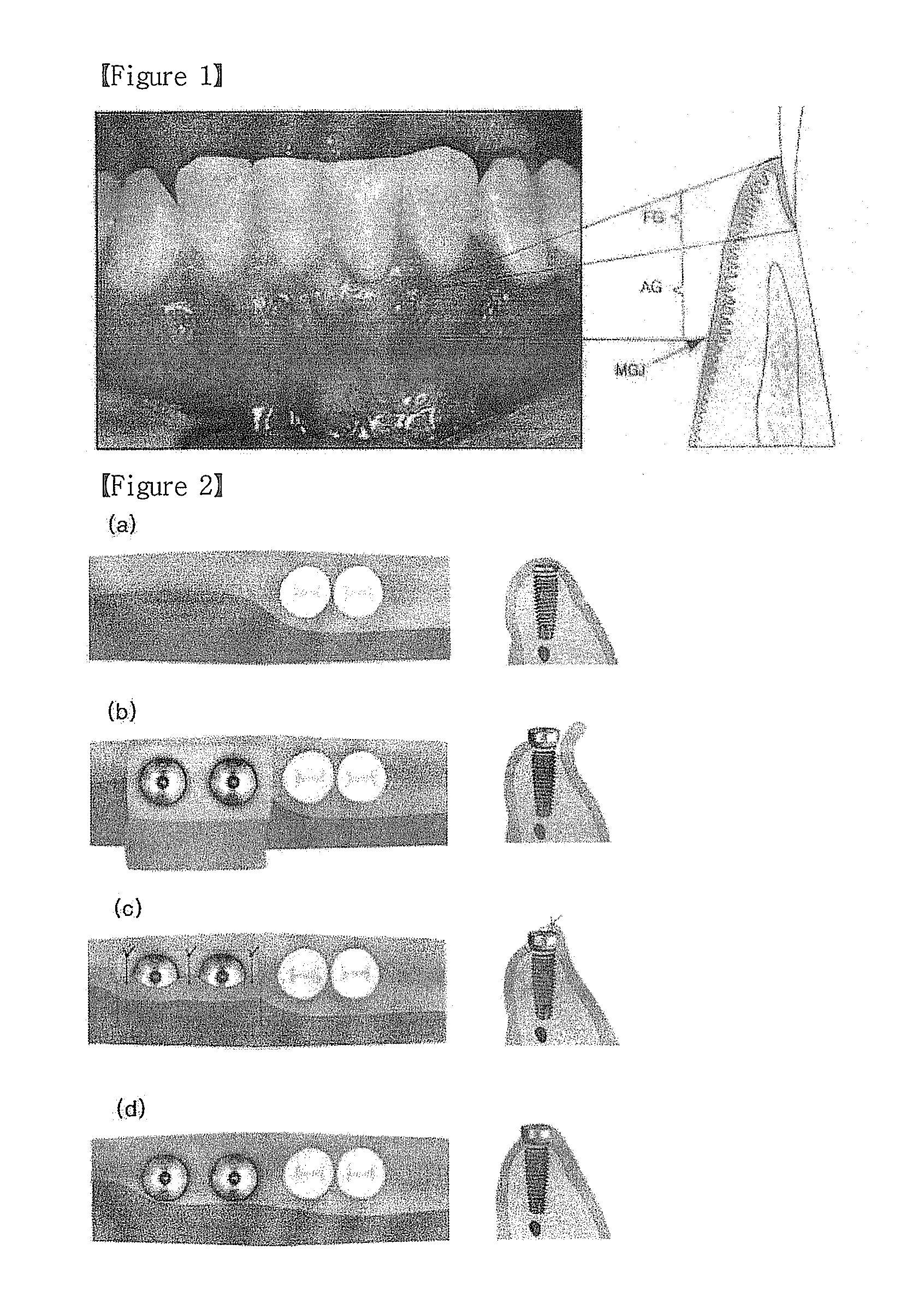 Button for implant healing abutment and implant healing abutment having pressing part