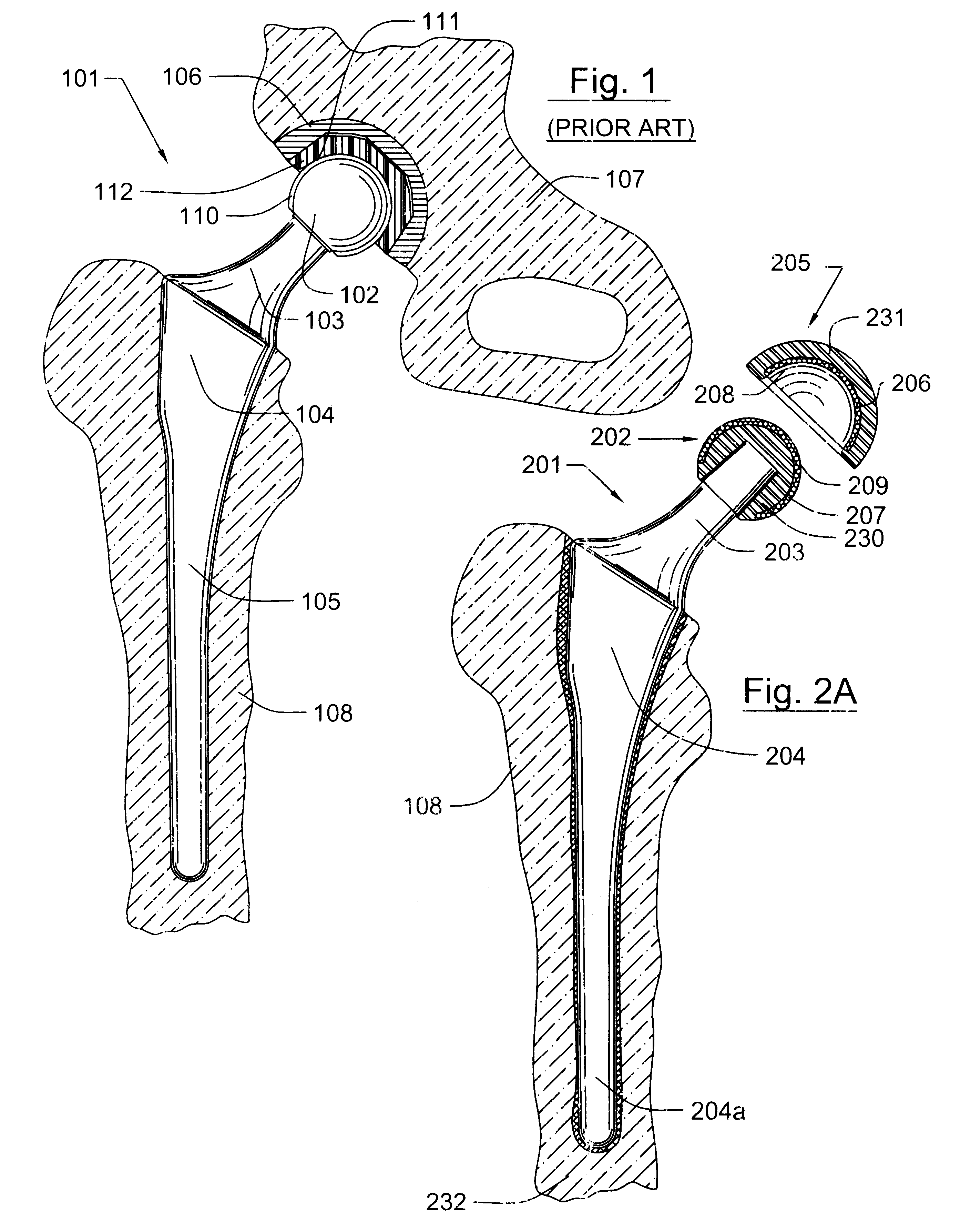 Prosthetic hip joint having sintered polycrystalline diamond compact articulation surfaces