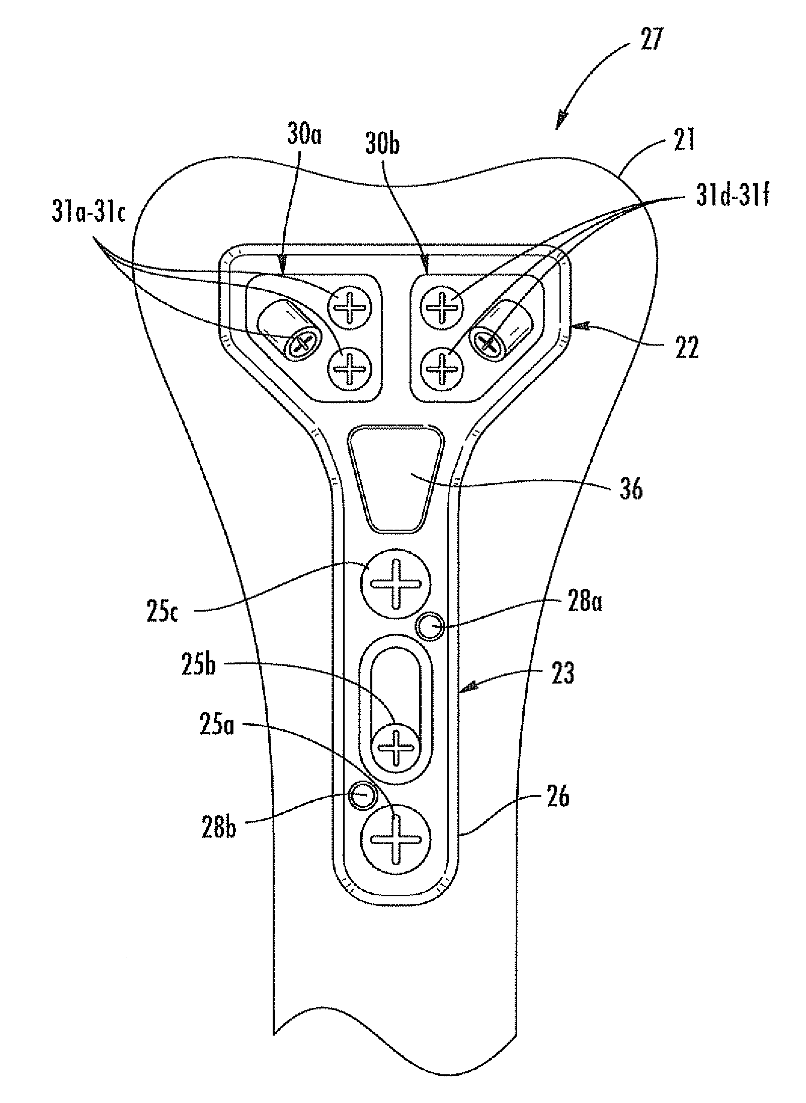 Modular bone fixation device for treatment of fractures and related methods