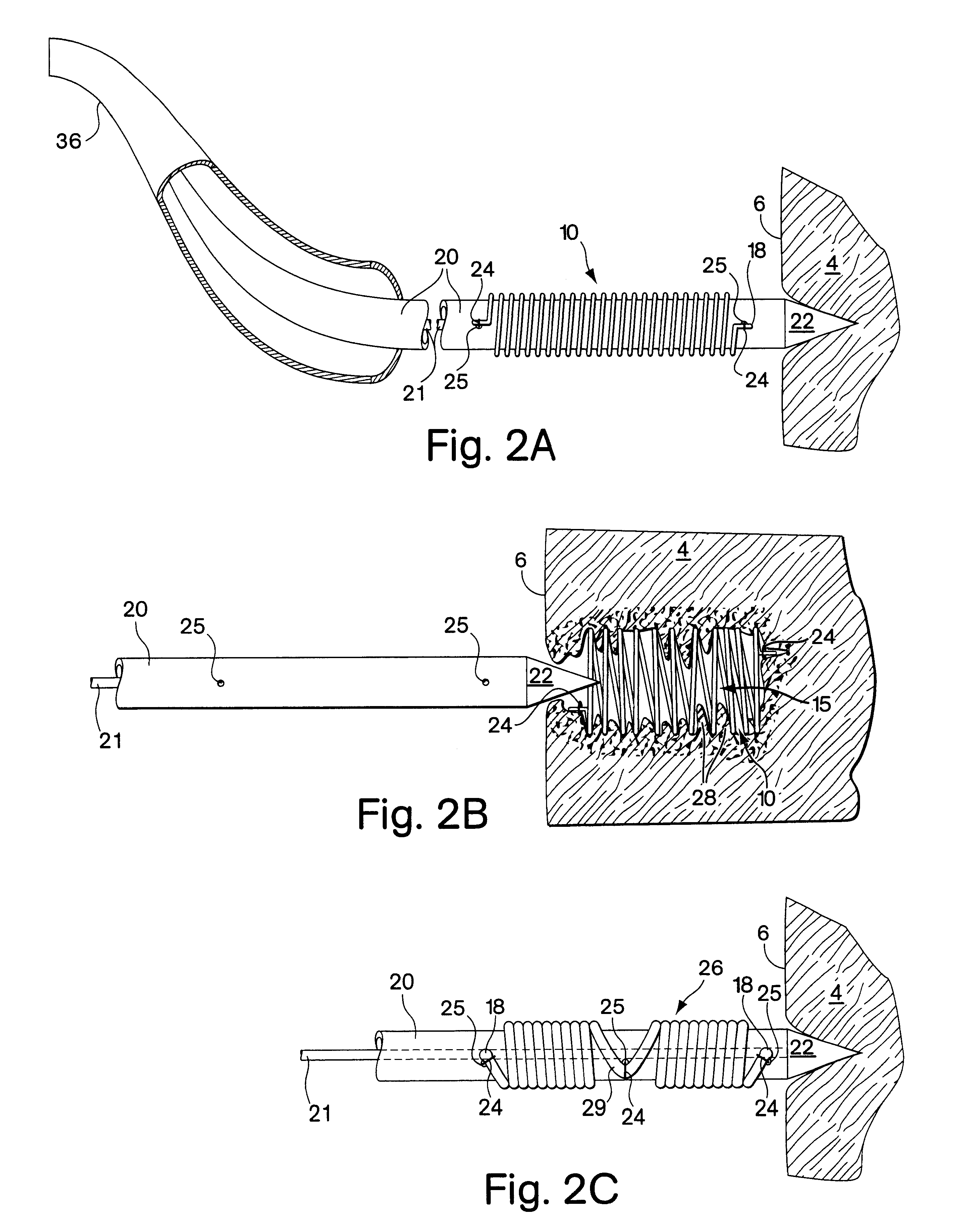 Vascular inducing implants