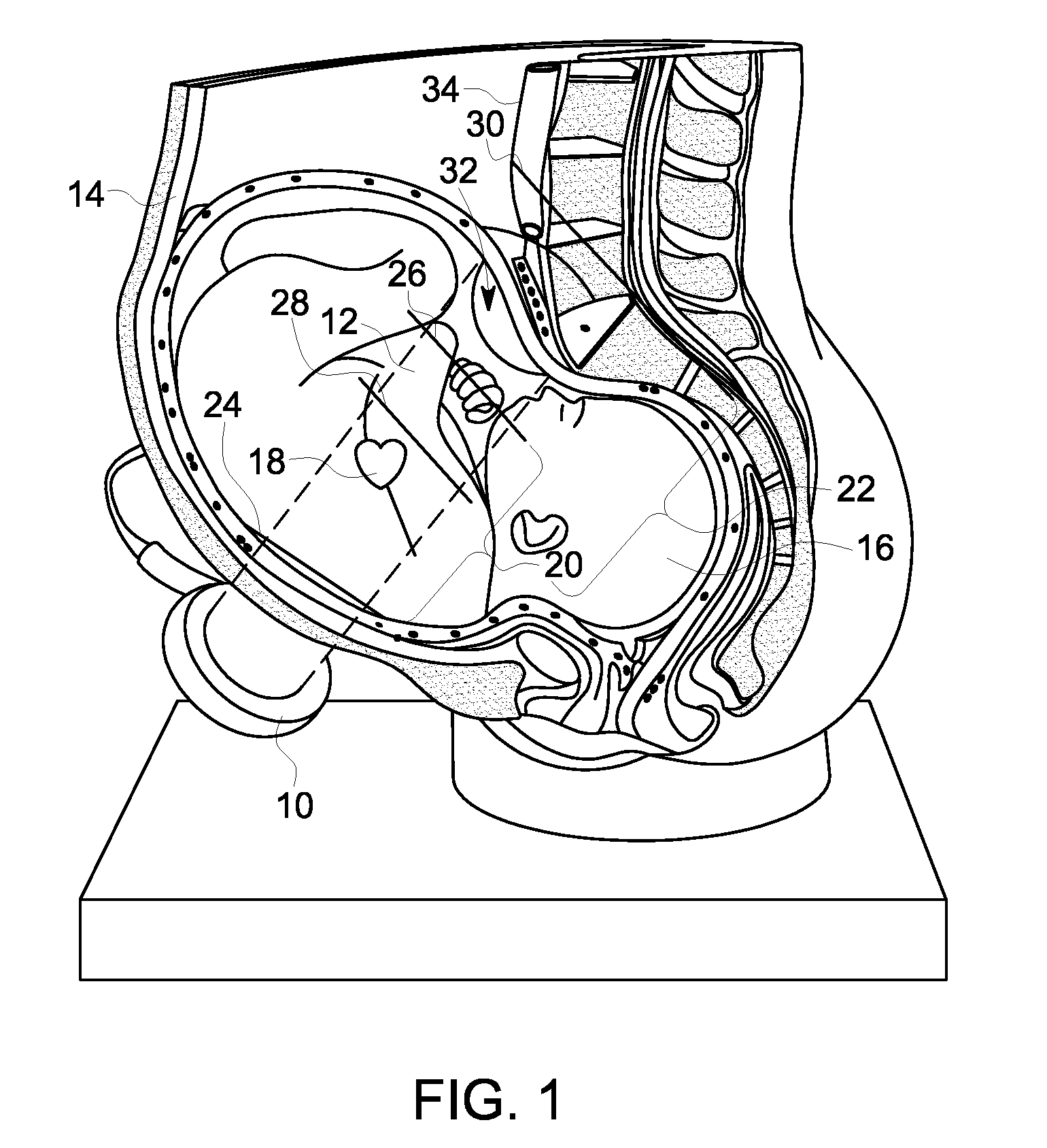 Method and Device for Fetal Heart Rate Monitoring with Maternal Contribution Detection