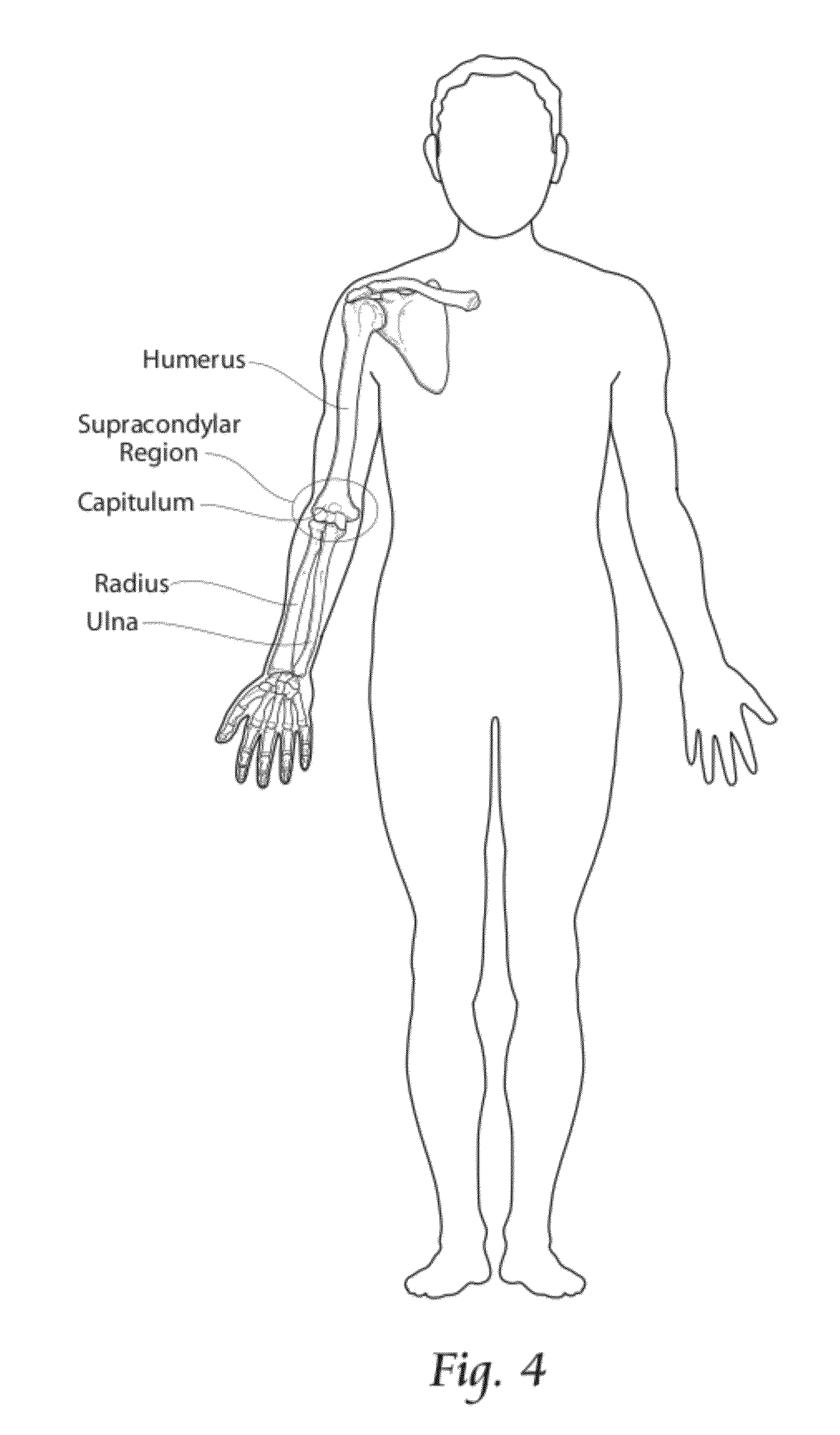 Systems, Devices, and Methods for Mechanically Reducing and Fixing Bone Fractures