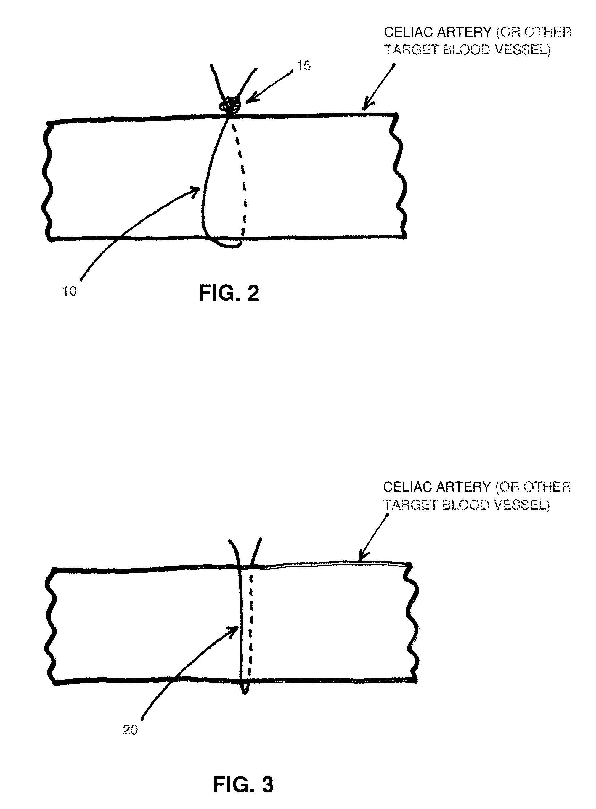 Method and apparatus for treating a patient by intentionally occluding a blood vessel, including method and apparatus for inducing weight loss in a patient by intentionally occluding the celiac artery