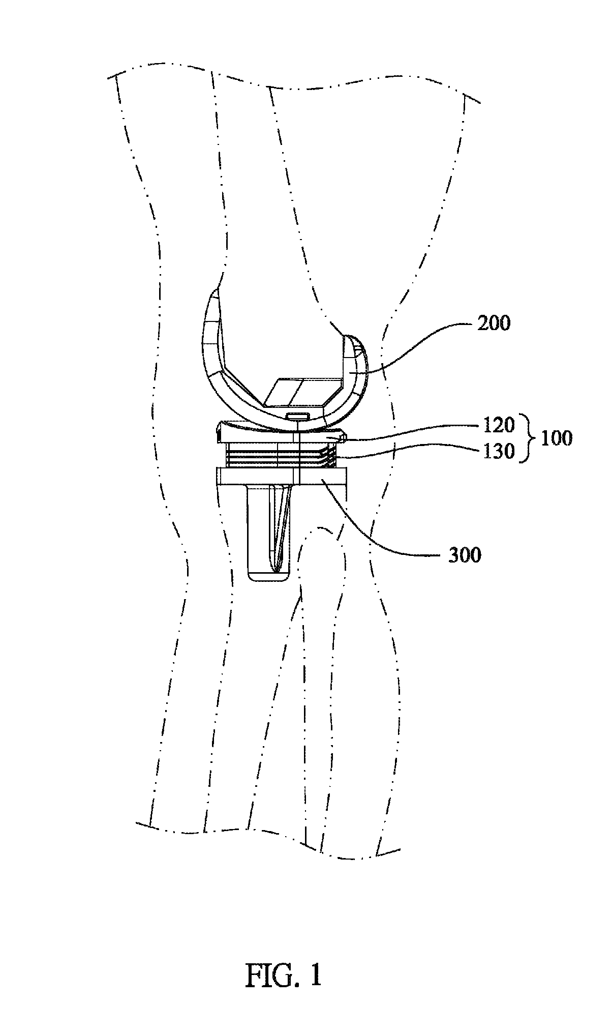 Stack-up assembly for tibial insert trial