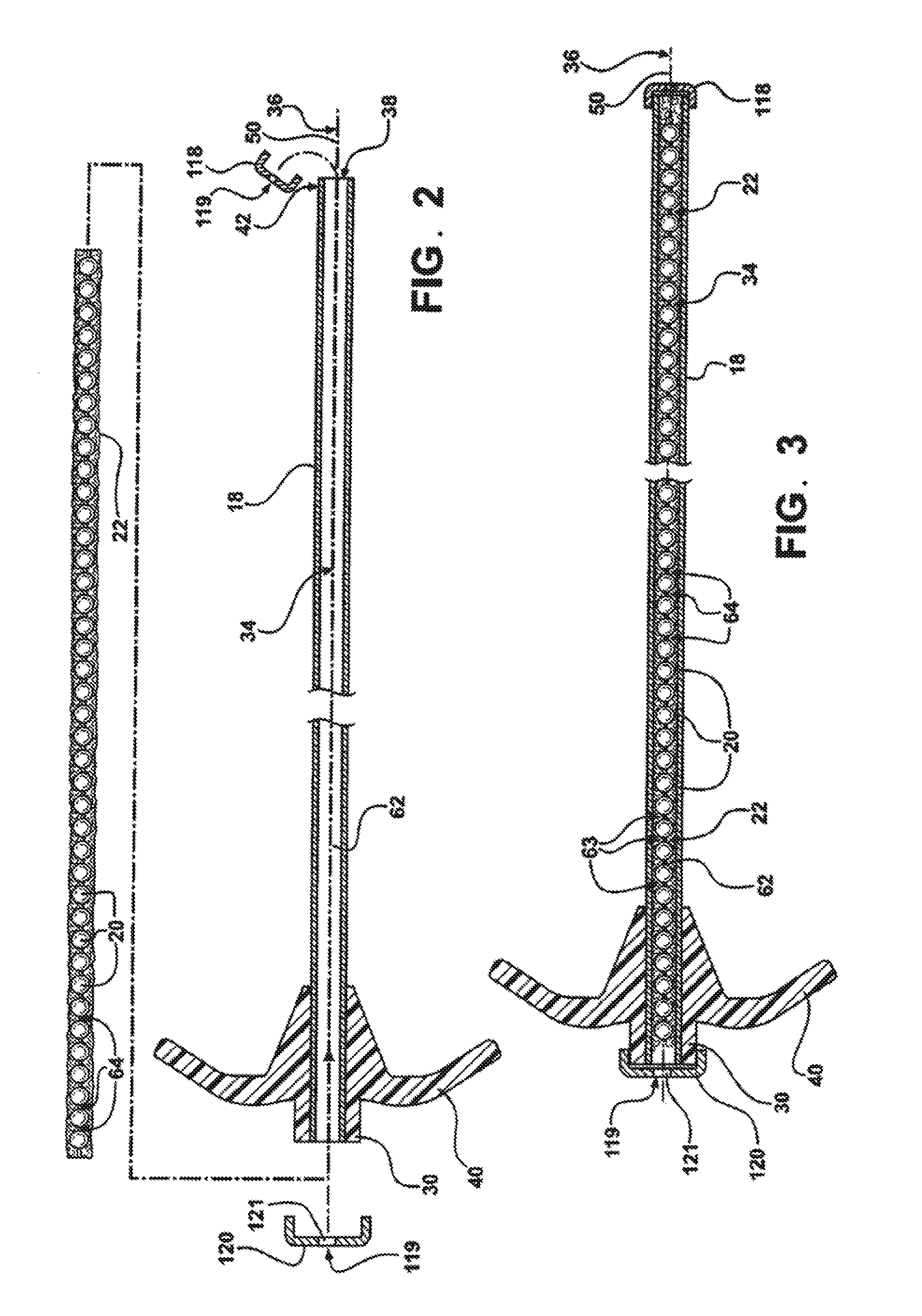 System and method for deliverying an agglomeration of solid beads and cement to the interior of a bone in order to form an implant within the bone