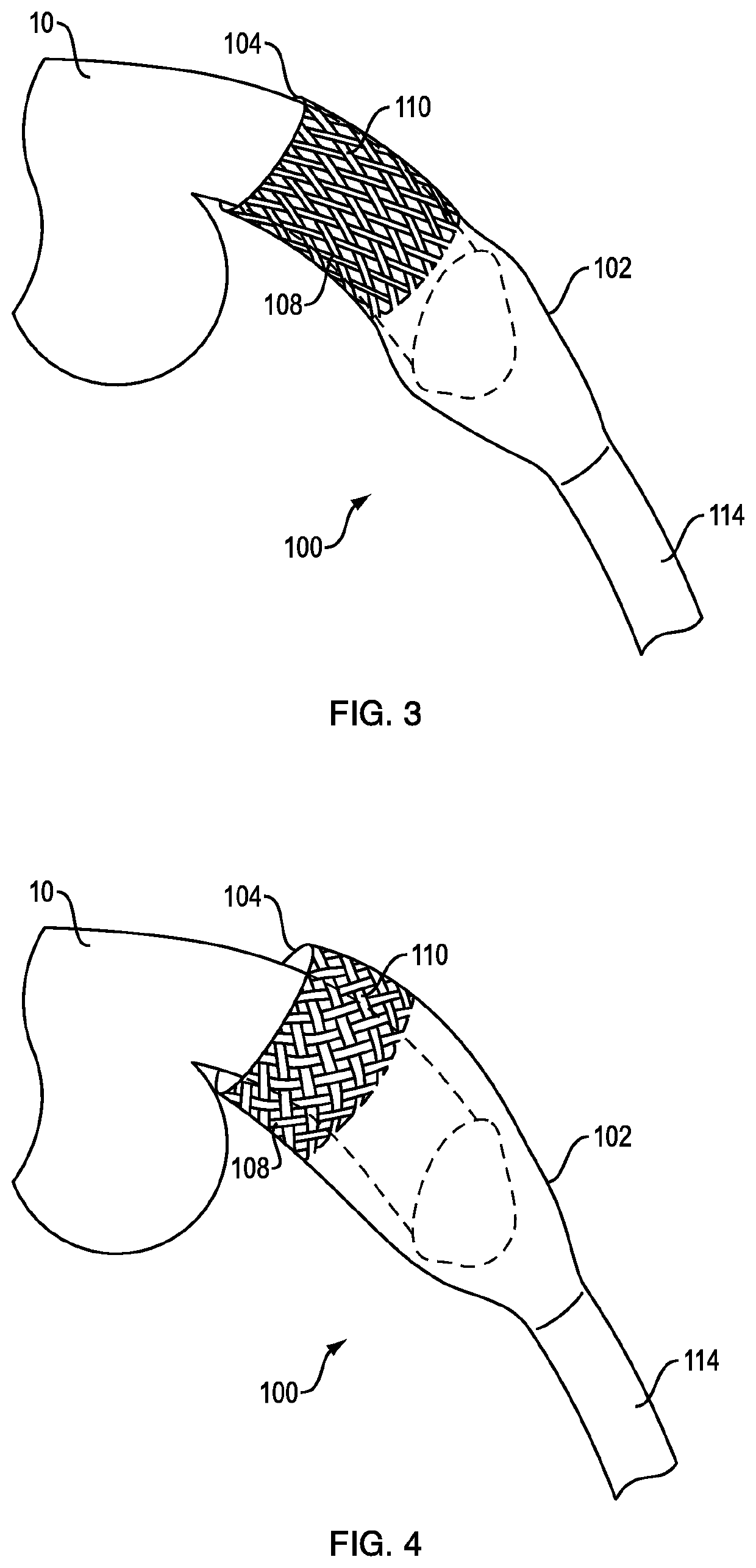 Male catheter