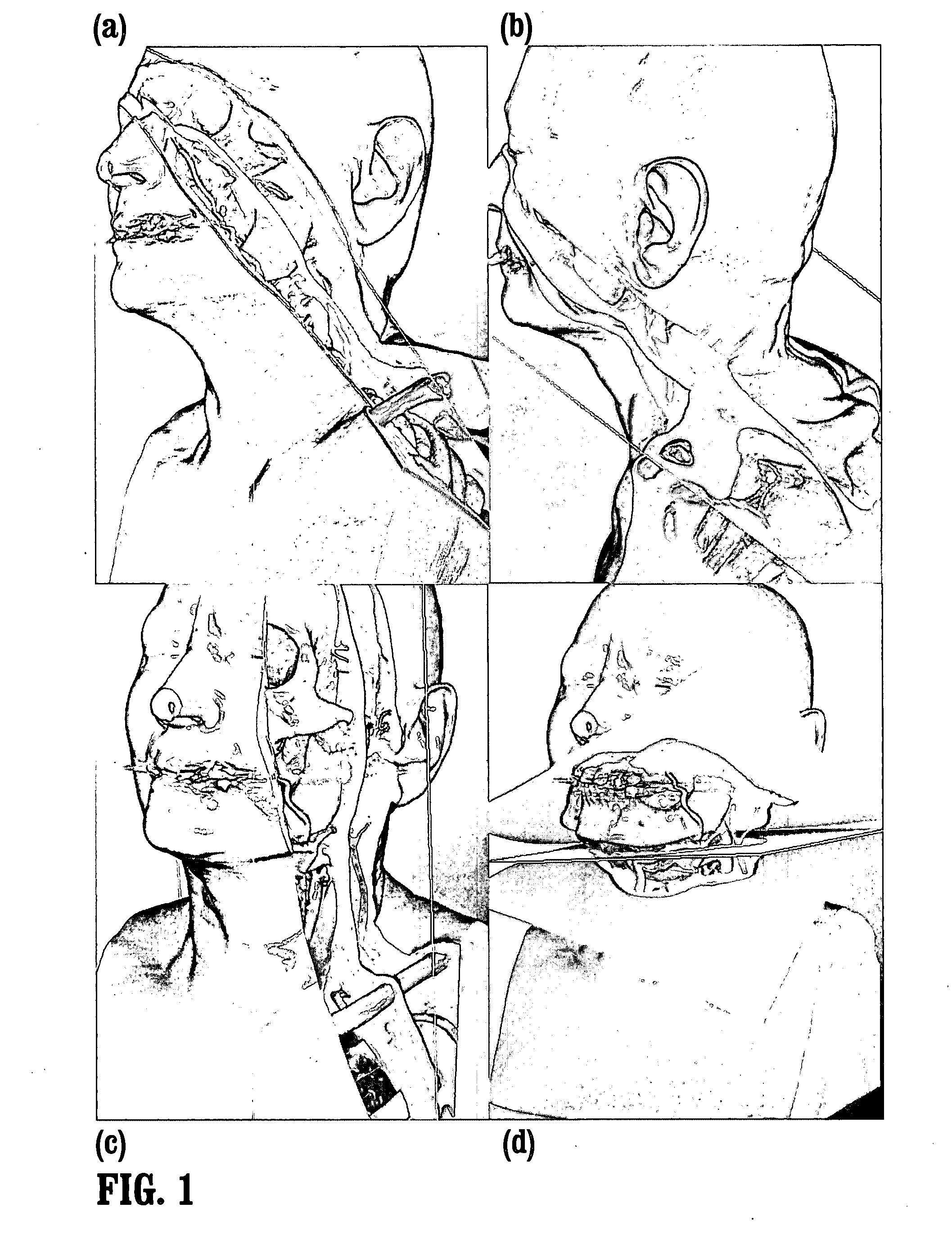 System and method for in-context mpr visualization using virtual incision volume visualization