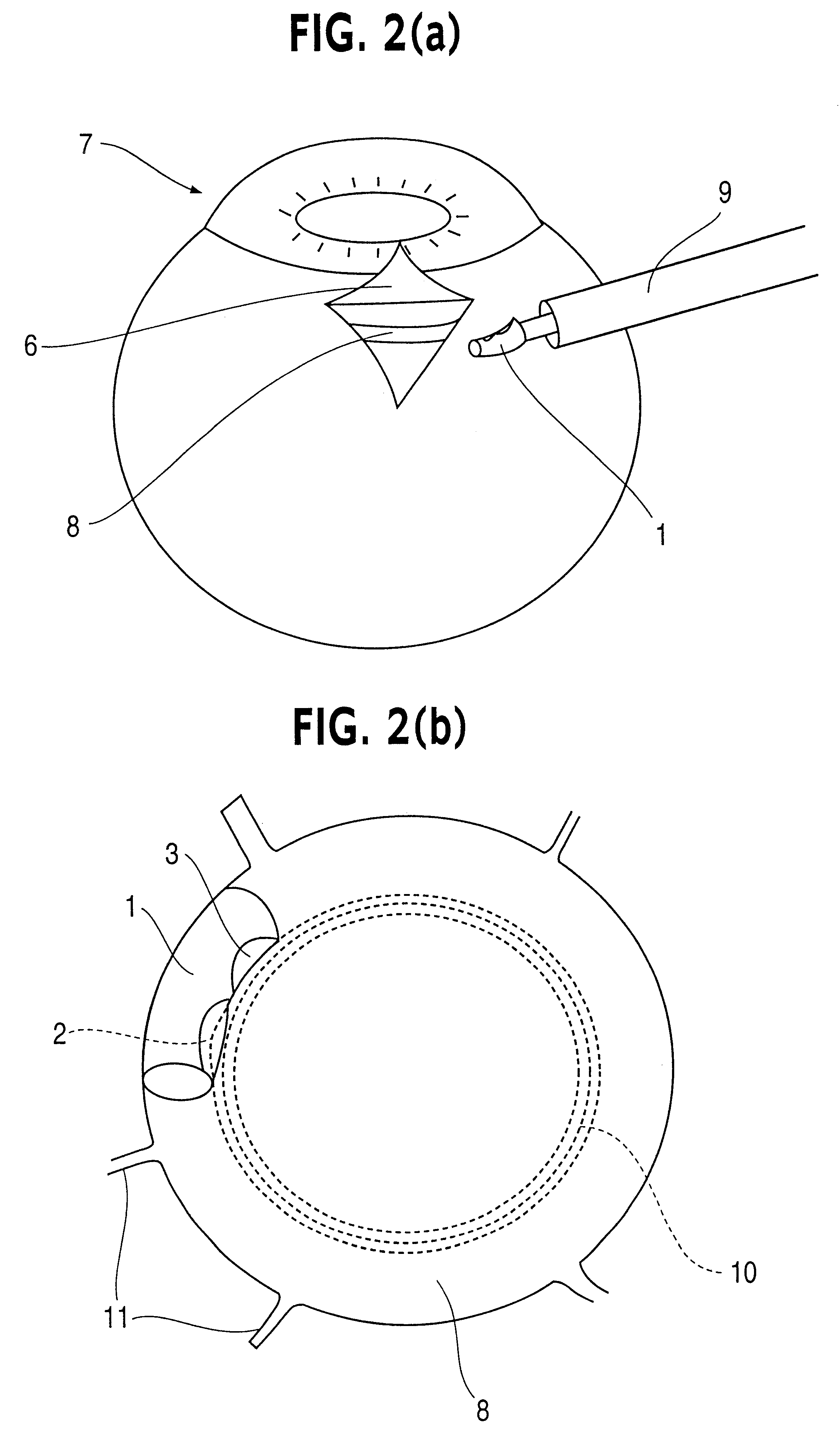 Device for improving in a targeted manner and/or permanently ensuring the ability of the aqueous humor to pass through the trabecular meshwork