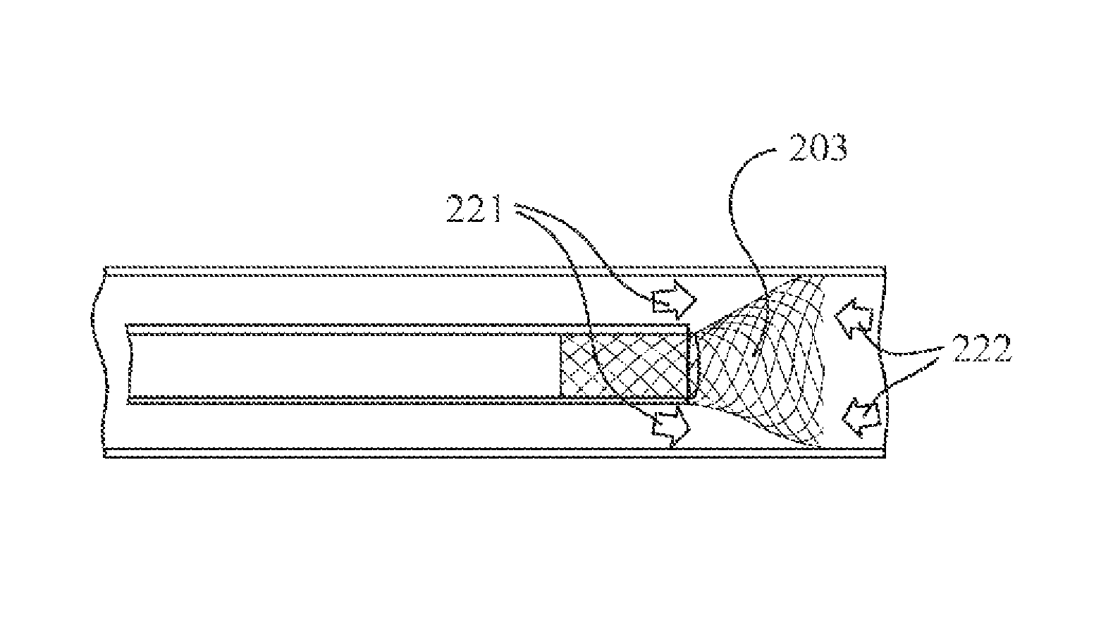 Microvalve protection device and method of use for protection against embolization agent reflux