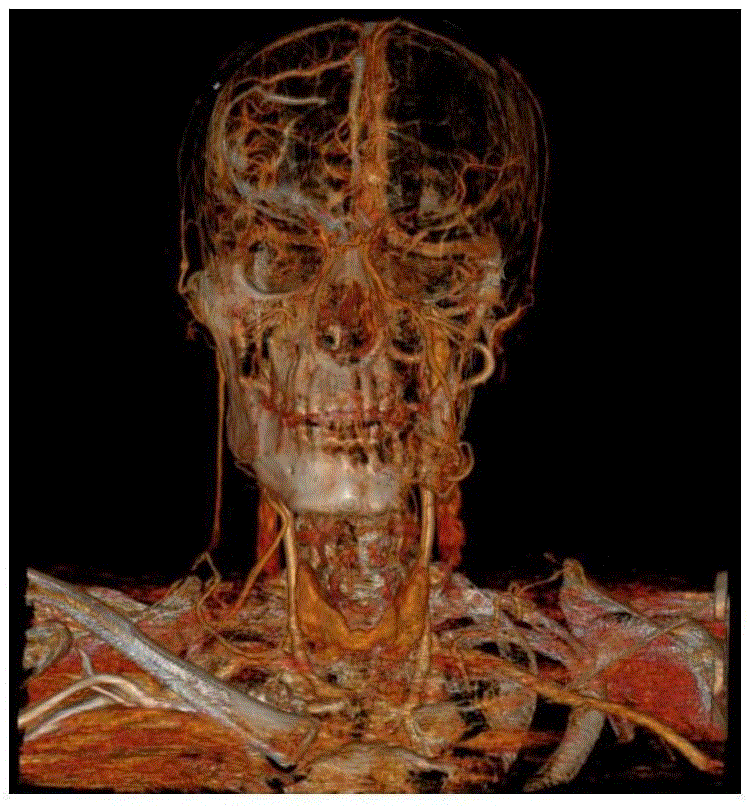 Angiography method