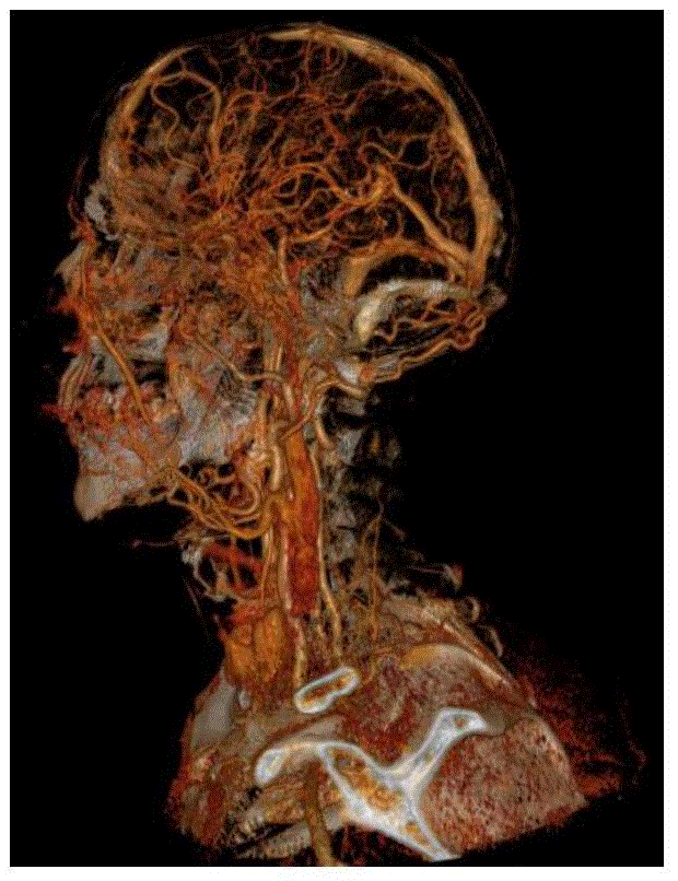 Angiography method