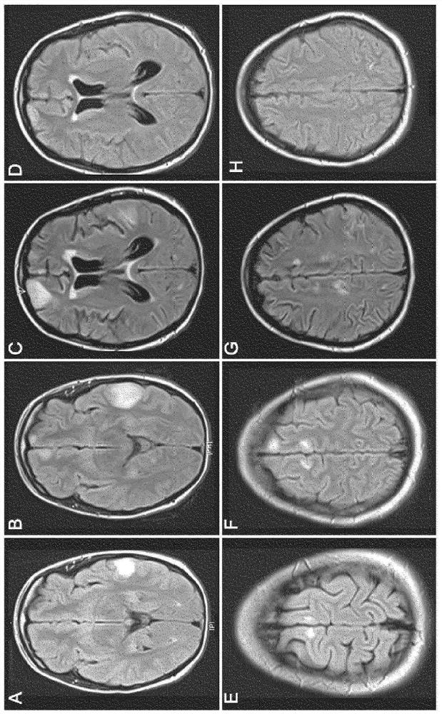 Diagnostic methods and related topics for the detection of GABA(a)-associated autoimmune diseases