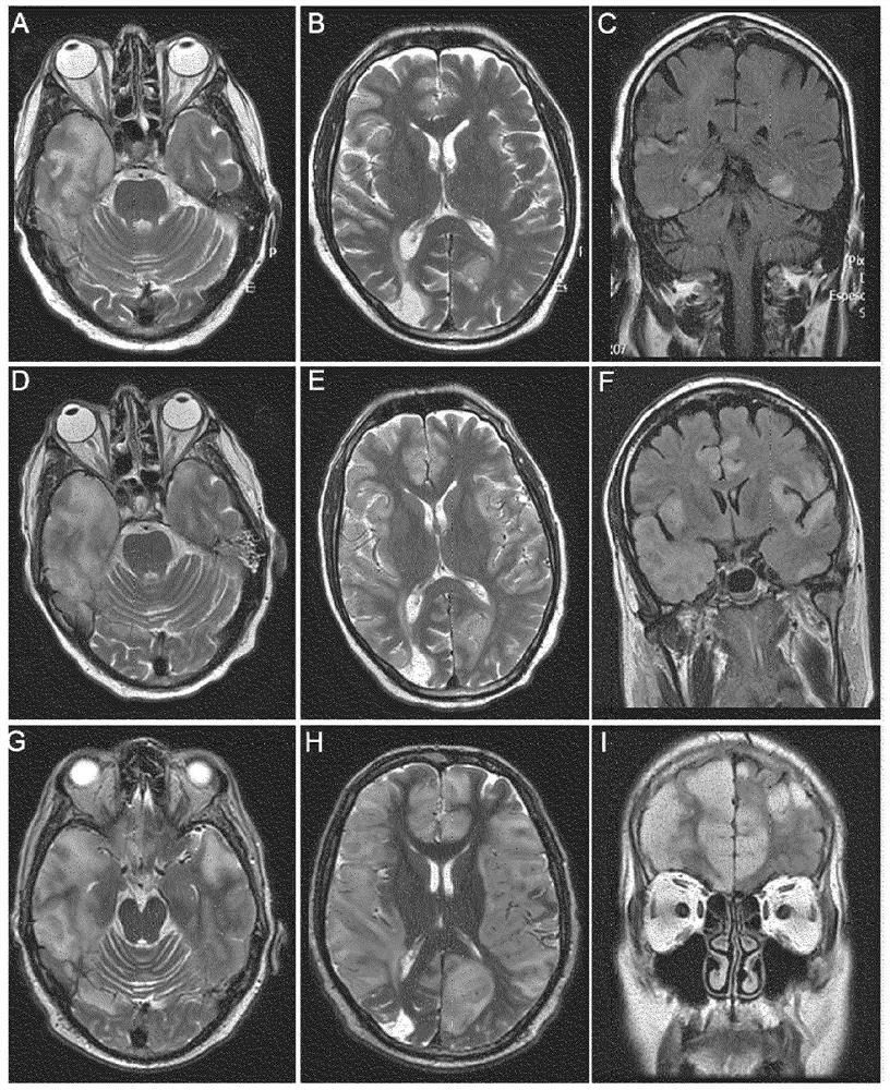 Diagnostic methods and related topics for the detection of GABA(a)-associated autoimmune diseases