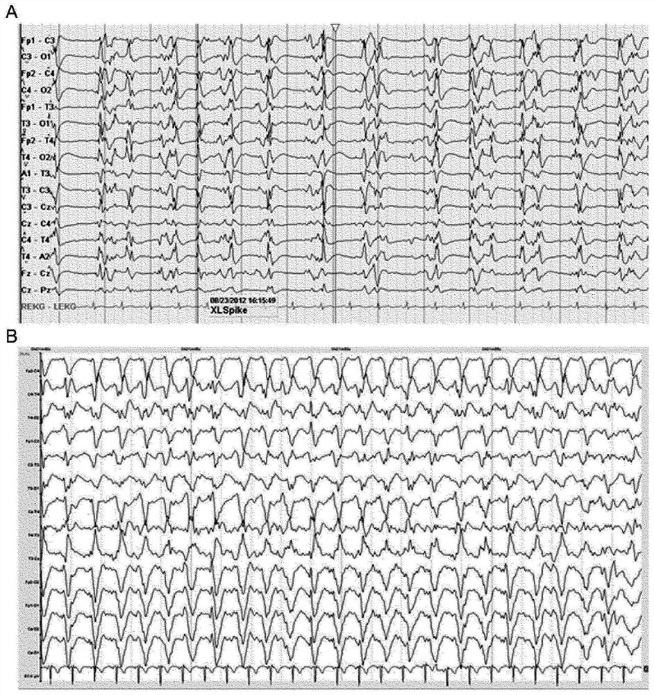 Diagnostic methods and related topics for the detection of GABA(a)-associated autoimmune diseases