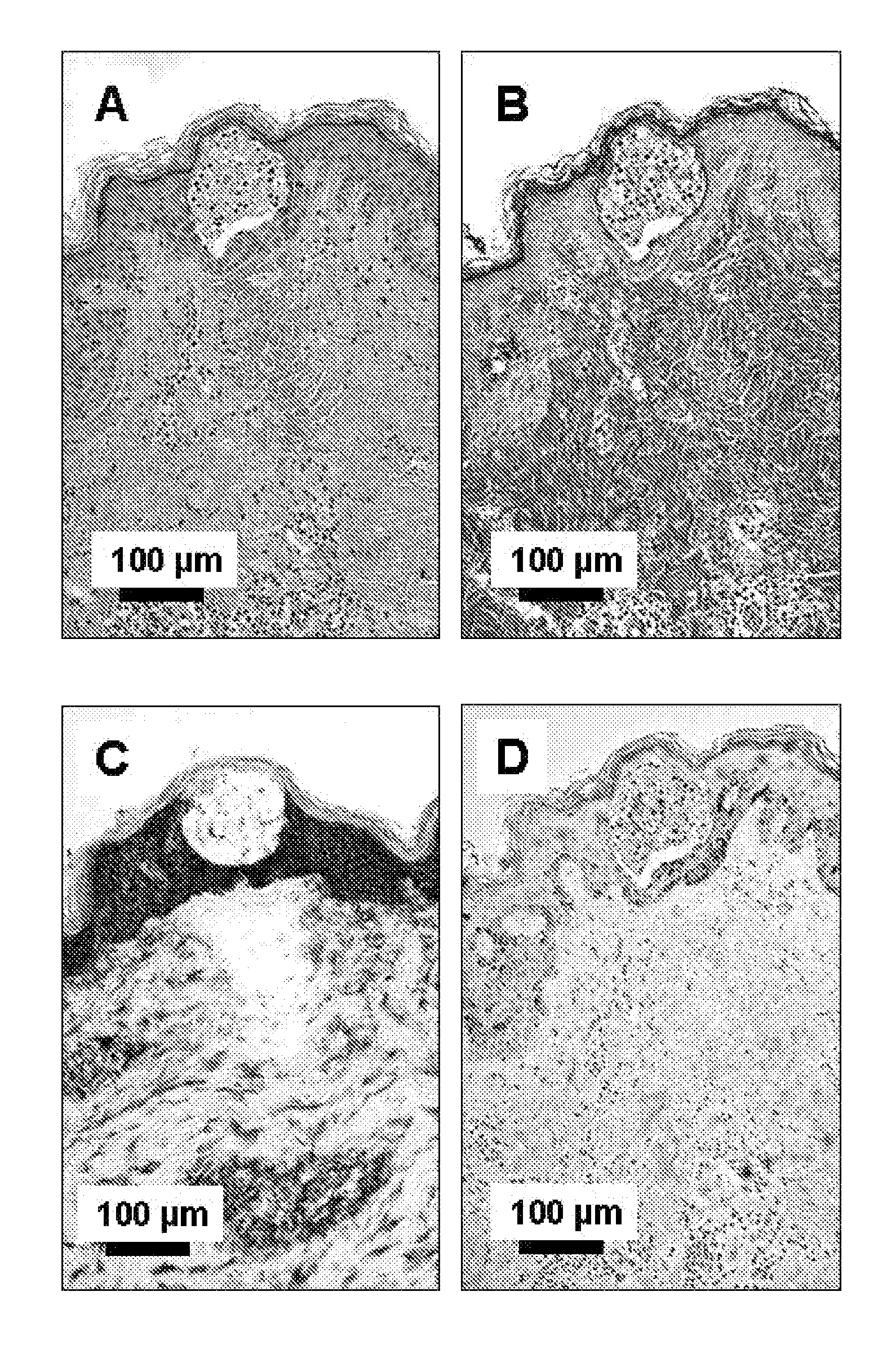 Laser-induced transepidermal elimination of content by fractional photothermolysis