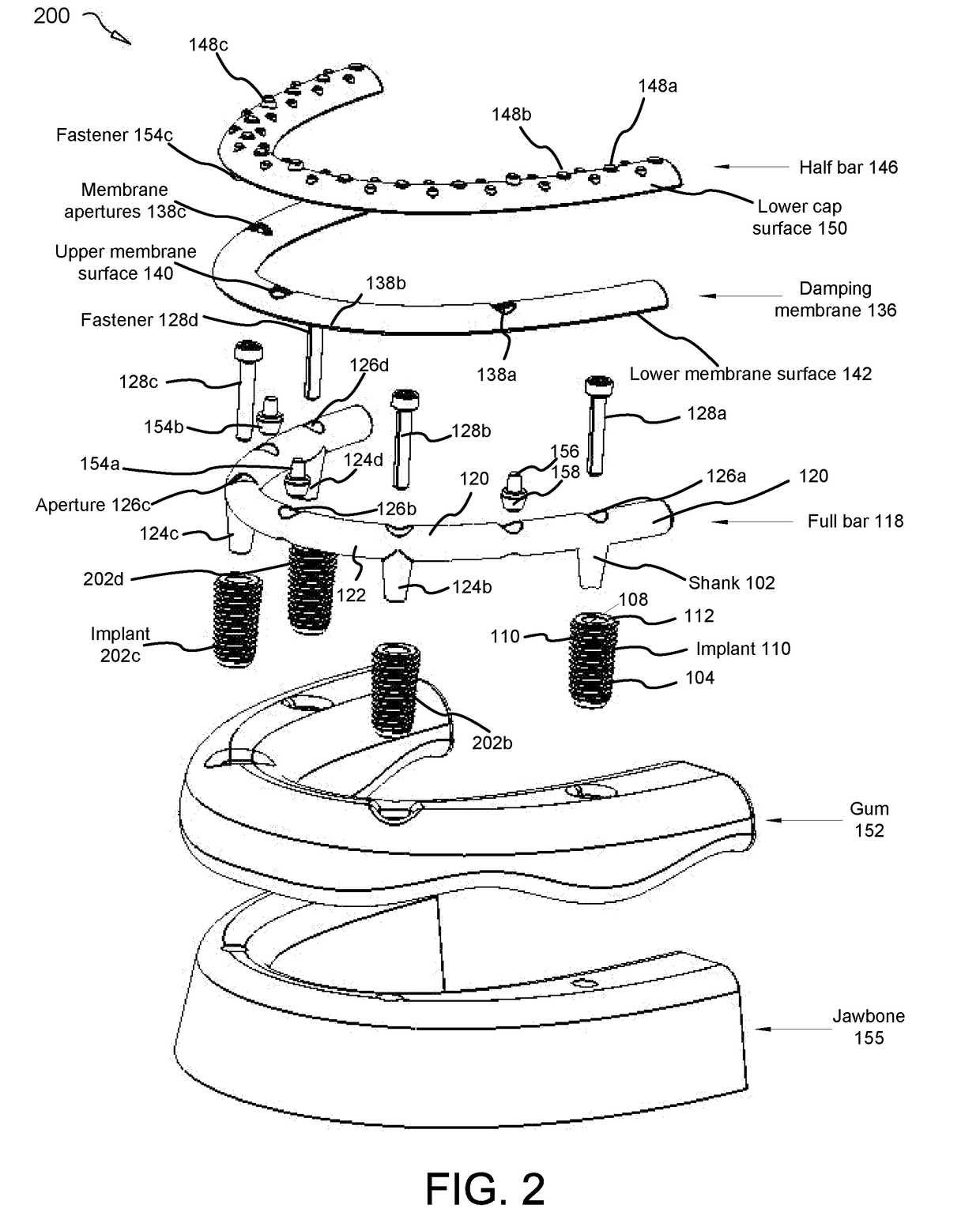 Force damping dental bridge assembly with synthetic periodontal ligament fibers