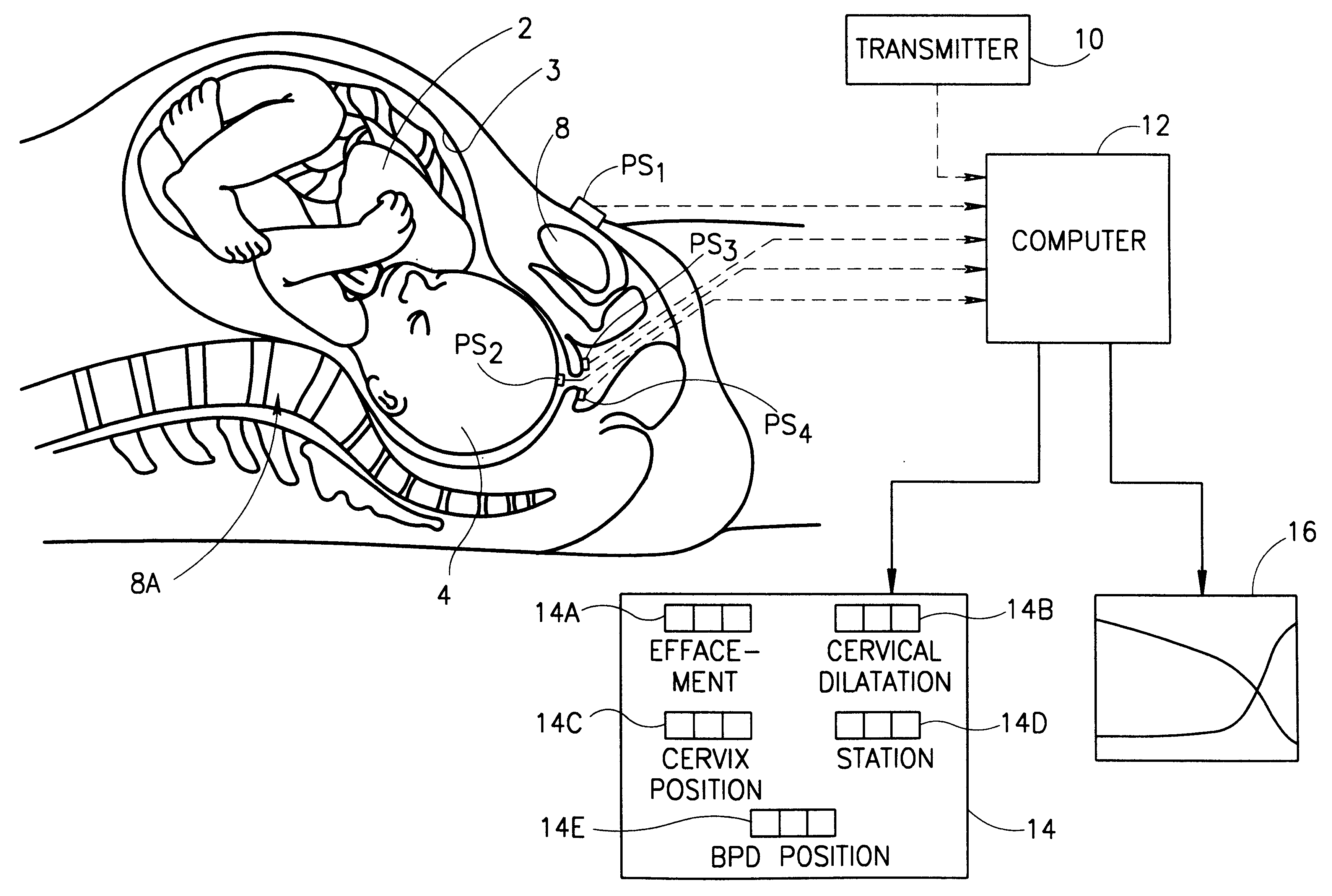 Method and apparatus monitoring the progress of labor