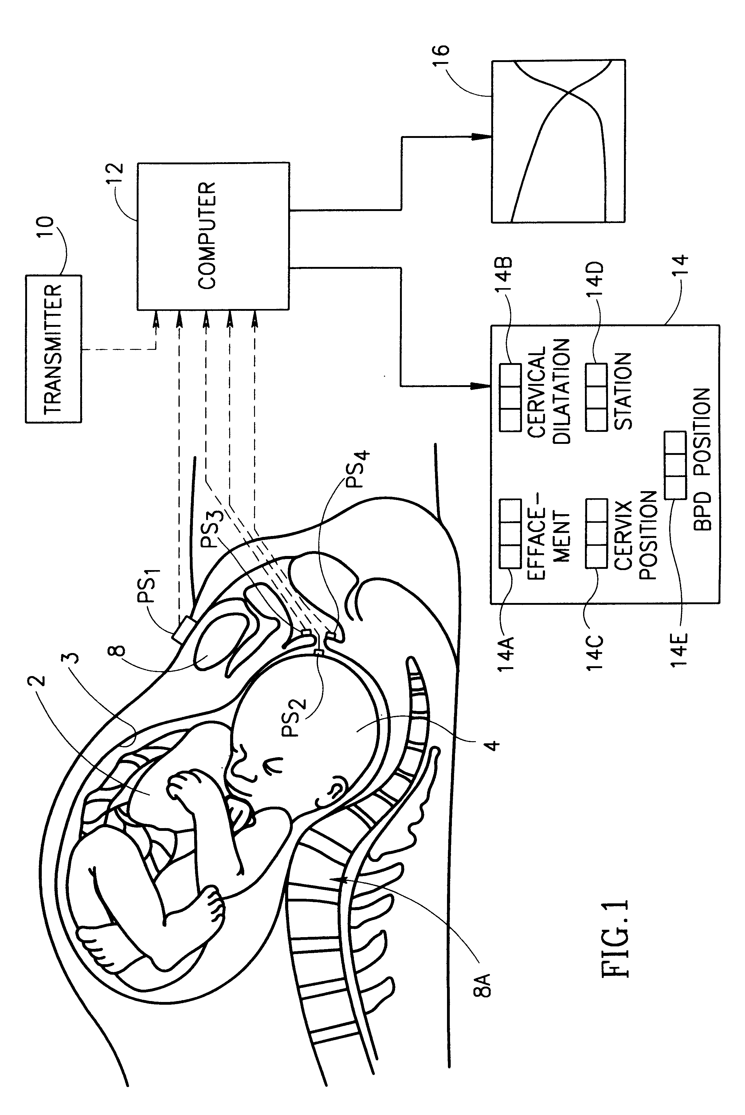 Method and apparatus monitoring the progress of labor