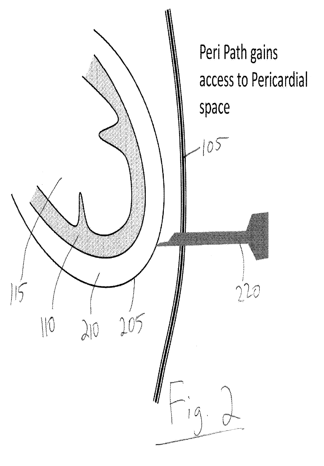 Devices and methods for image-guided percutaneous cardiac valve implantation and repair