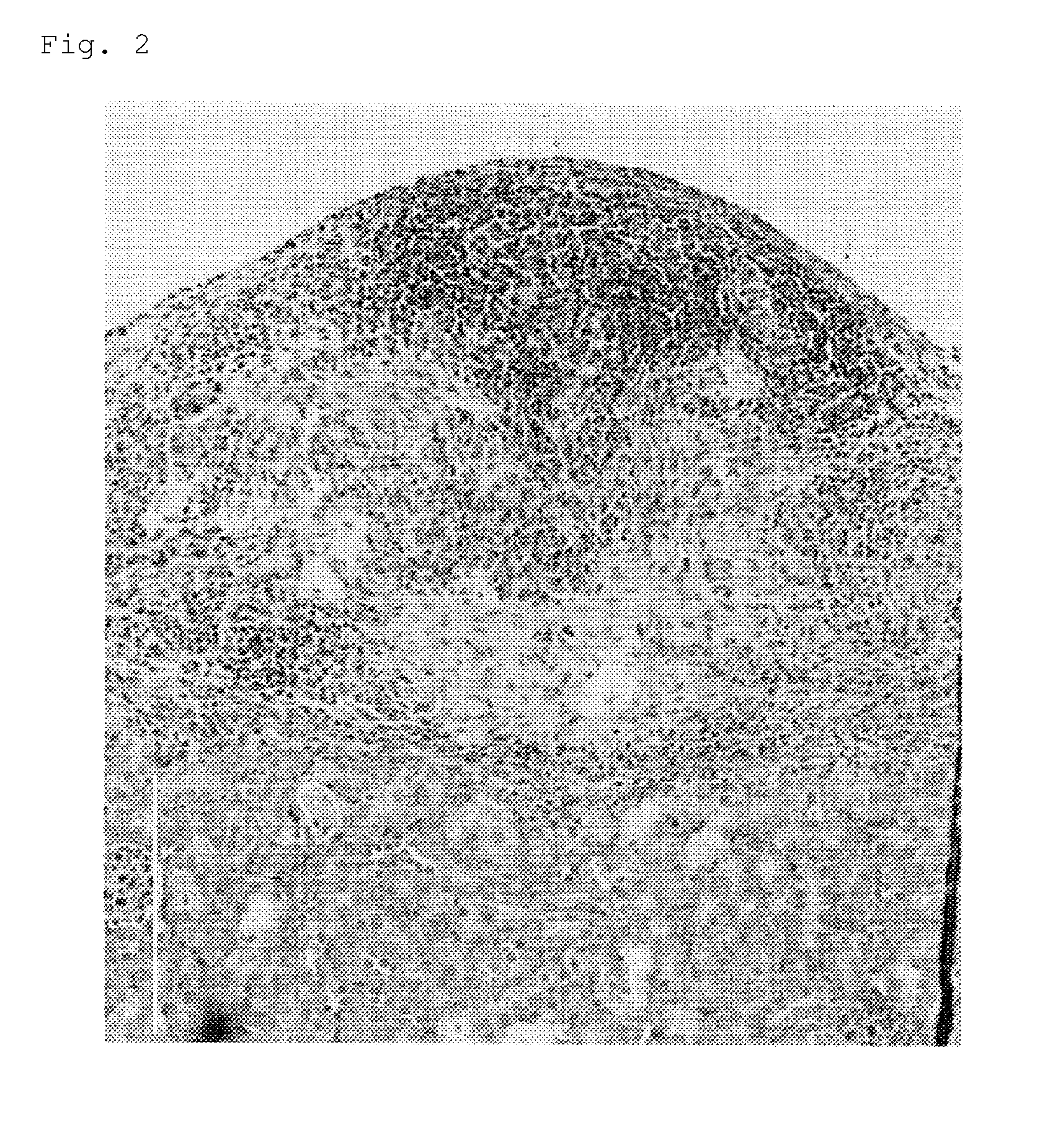 Islets of langerhans transplant using islets of langerhans and adipose tissue derived stem cells