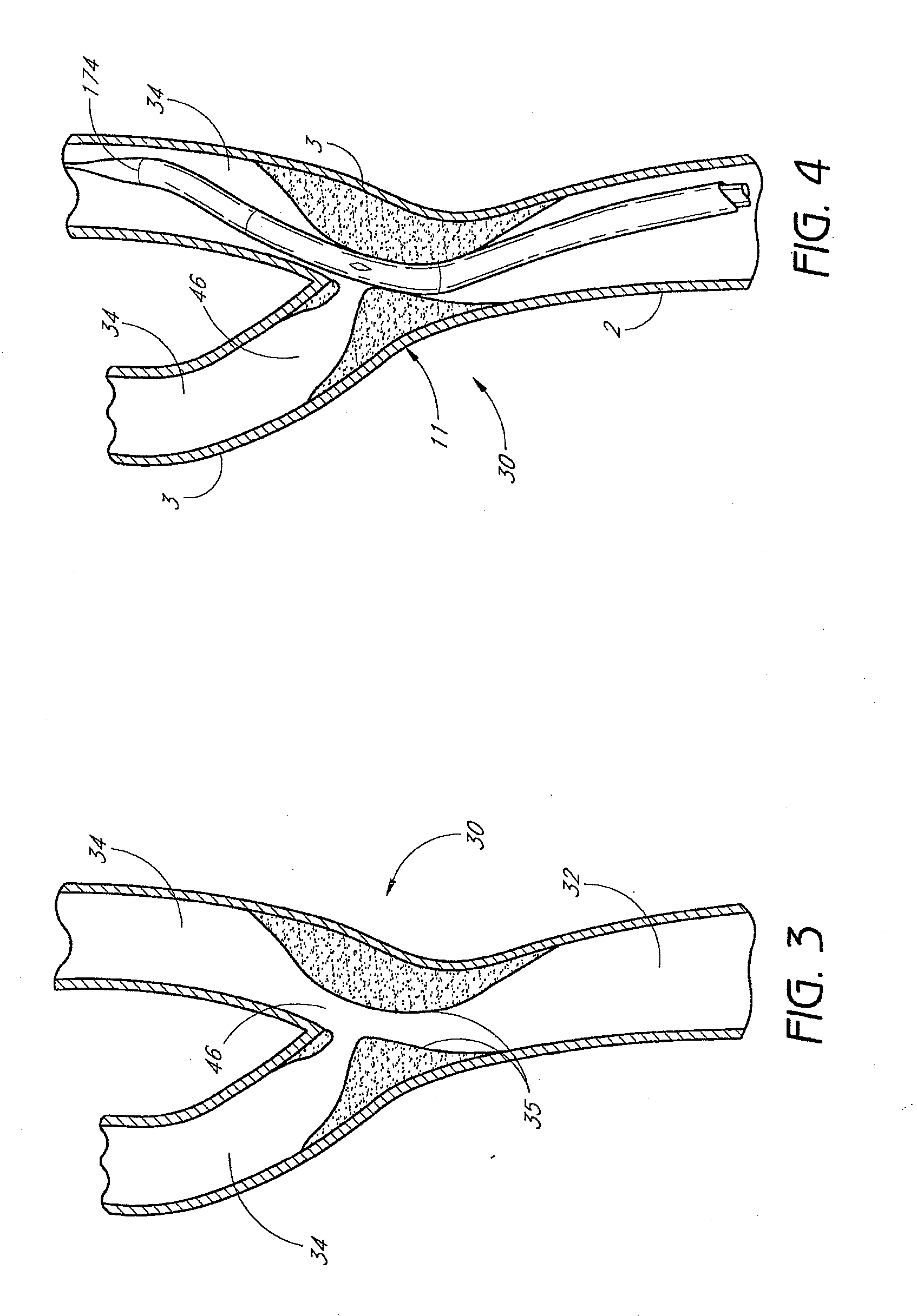 Bifurcation stent and method of positioning in a body lumen