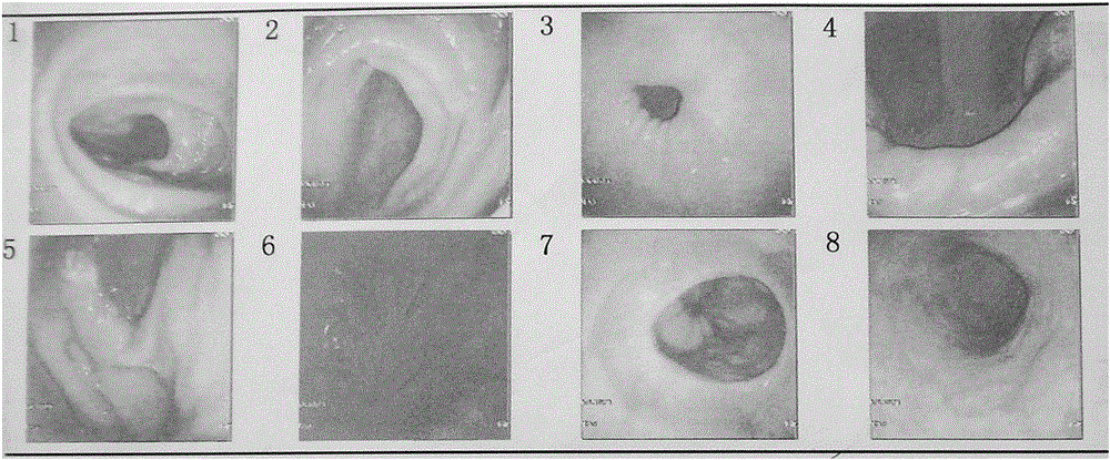 Immune cell preparation for treating chronic atrophic gastritis and gastric precancerous lesions and preparation method and application of immune cell preparation